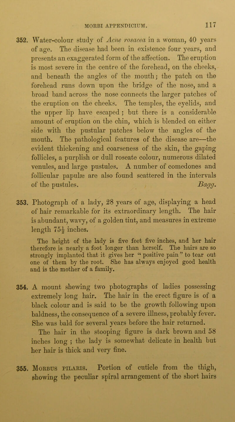 352. Water-colour study of Acne rosacea in a woman, 40 years of age. The disease had been in existence four years, and presents an exaggerated form of the affection. The eruption is most severe in the centre of the forehead, on the cheeks, and beneath the angles of the mouth; the patch on the forehead runs down upon the bridge of the nose, and a broad band across the nose connects the larger patches of the eruption on the cheeks. The temples, the eyelids, and the upper lip have escaped ; but there is a considerable amount of eruption on the chin, which is blended on either side with the pustular patches below the angles of the mouth. The pathological features of the disease are—the evident thickening and coarseness of the skin, the gaping follicles, a purplish or dull roseate colour, numerous dilated venules, and large pustules. A number of comedones and follicular papulae are also found scattered in the intervals of the pustules. ^<^99- 353. Photograph of a lady, 28 years of age, displaying a head of hair remarkable for its extraordinary length. The hair is abundant, wavy, of a golden tint, and measures in extreme length 75-^ inches. The height of the lady is five feet five inches, and her hair therefore is nearly a foot longer than herself. The hairs are so strongly implanted that it gives her “ positive pain ” to tear out one of them by the root. She has always enjoyed good health and is the mother of a family. 354. A mount shewing two photographs of ladies possessing extremely long hair. The hair in the erect figure is of a black colour and is said to be the growth following upon baldness, the consequence of a severe illness, probably fever. She was bald for several years before the hair returned. The hair in the stooping figure is dark brown and 58 inches long ; the lady is somewhat delicate in health but her hair is thick and very fine. 355. Morbus pilaris. Portion of cuticle from the thigh, showing the peculiar spiral arrangement of the short hairs