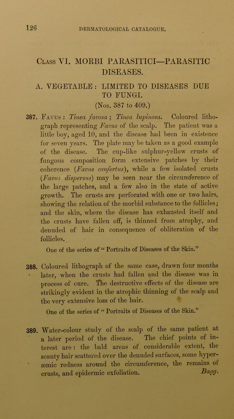 Class VI. MORBI PARASITICI—PARASITIC DISEASES. A. VEGETABLE : LIMITED TO DISEASES DUE TO FUNGI. (Nos. 387 to 409.) 387. Favus : J'inea favosa ; Tinea lupinosa. Coloured litho- graph representing Favus of the scalp. The patient was a little boy, aged 10, and the disease had been in existence for seven years. The plate may be taken as a good example of the disease. The cup-like sulphur-yellow crusts of fungous composition form extensive patches by their coherence {Favus confertus), while a few isolated crusts [Favus dispersus) may be seen near the circumference of the large patches, and a few also in the state of active growth. The crusts are perforated with one or two hairs, showing the relation of the morbid substance to the follicles; and the skin, where the disease has exhausted itself and the crusts have fallen ofP, is thinned from atrophy, and denuded of hair in consequence of obliteration of the follicles. One of the series of “ Portraits of Diseases of the Skin.” 388. Coloured lithograph of the same case, drawn four months * later, when the crusts had fallen and the disease was in process of cure. The destructive effects of the disease are strikingly evident in the atrophic thinning of the scalp and the very extensive loss of the hair. One of the series of “ Portraits of Diseases of the Skin.” 389. Water-colour study of the scalp of the same patient at a later period of the disease. The chief points of in- terest are: the bald areas of considerable extent, the scanty hair scattered over the denuded surfaces, some hyper- ’ semic redness around the circumference, the remains of crusts, and epidermic exfoliation. Bagg.
