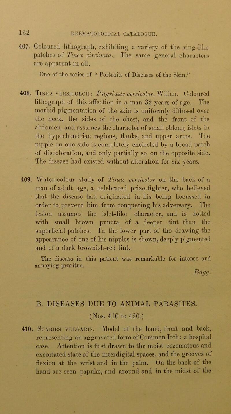 407. Oolourod litliograph, exliibiting a variety of the ring-like patches of Tinea circinata.. The same general characters are apparent in all. One of the series of “ Portraits of Diseases of the Skin.” 408. Tinea versicolor : Pityriasis versicolor, Willan. Coloured lithograph of this affection in a man 32 years of age. The morbid pigmentation of the skin is uniformly diffused over the neck, the sides of the chest, and the front of the abdomen, and assumes the character of small oblong islets in the hypochondriac regions, flanks, and upper arms. The nipple on one side is completely encircled by a broad patch of discoloration, and only partially so on the opposite side. The disease had existed without alteration for six years. 409. Water-colour study of Tinea versicolor on the back of a man of adult age, a celebrated prize-fighter, who believed that the disease had originated in his being hocussed in order to. prevent him from conquering his adversary. The lesion assumes the islet-like character, and is dotted with small brown puncta of a deeper tint than the superficial patches. In the lower part of the drawing the appearance of one of his nipples is shown, deeply pigmented and of a dark brownish-red tint. The disease in this patient was remarkable for intense and annoying pruritus. Bagg. B. DISEASES DUE TO ANIMAL PARASITES. (Nos. 410 to 420.) 410. Scabies vulgaris. Model of the hand, front and back, representing an aggravated form of Common Itch: a hospital case. Attention is first drawn to the moist eczematous and excoriated state of the interdigital spaces, and the grooves of flexion at the wrist and in the palm. On the back of the hand are seen papulae, and around and in the midst of the