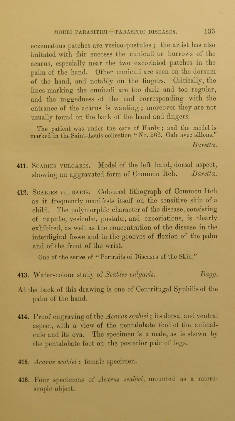 eczematous patches are vesico-pustules ; the artist has also imitated with fair success the cuniculi or burrows of the acarus, especially near the two excoriated patches in the palm of the hand. Other cuniculi are seen on the dorsum of the hand, and notably on the fingers. Critically, the lines marking the cuniculi are too dark and too regular, and the raggedness of the end corresponding with the entrance of the acarus is wanting ; moreover they are not usually found on the back of the hand and fingers. The patient was under the care of Hardy ; and the model is marked in the Saint-Louis collection “ Ho. 266. Gale avec sillons.” Baretta. 411. Scabies vulgaris. Model of the left hand, dorsal aspect, showing an aggravated form of Common Itch. Baretta. 412. Scabies vulgaris. Coloured lithograph of Common Itch as it frequently manifests itself on the sensitive skin of a child. The polymorphic character of the disease, consisting of papulie, vesiculse, pustulse, and excoriations, is clearly exhibited, as well as the concentration of the disease in the interdigital fossae and in the grooves of flexion of the palm and of the front of the wrist. One of the series of “ Portraits of Diseases of the Skin.” 413. Water-colour study of Scabies vulgaris. Bagg. At the back of this drawing is one of Centrifugal Syphilis of the palm of the hand. 414. Proof engraving of the Acarus scabiei; its dorsal and ventral aspect, with a view of the pentalohate foot of the animal- cule and its ova. The specimen is a male, as is shown by the pentalohate foot on the posterior pair of legs. 415. Acanis scabiei : female specimen. 416. Four specimens of Amarus scabiei, mounted as a micro- scopic object.