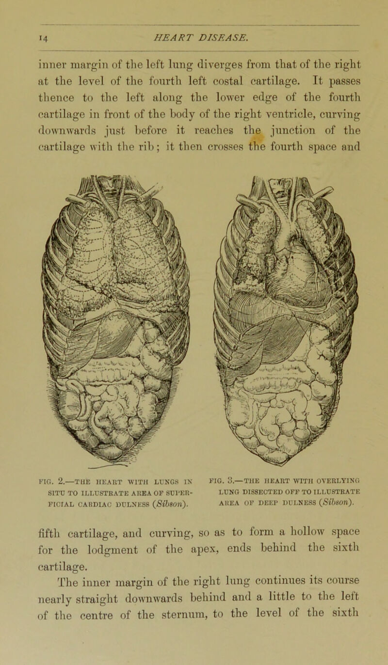 inner margin of tlie left lung diverges from that of the right at the level of the fourth left costal cartilage. It passes thence to the left along the lower edge of the fourth cartilage in front of the body of the right ventricle, curving downwards just before it reaches the junction of the cartilage witli the rib; it then crosses the fourth space and riG. 2.—THE HEART -WITH LUNGS IN NIG. 3.—THE HEART WITH OVERLYING SITU TO ILLUSTRATE AREA OF SUFER- LUNG DISSECTED OFF TO ILLUSTRATE FICIAL CARDIAC DULNESS {SUson). AREA OP DEEP DULNESS QSihson). fifth cartilage, and curving, so as to form a hollow space for the lodgment of the apex, ends behind the sixth cartilage. The inner margin of the right lung continues its course nearly straight downwards behind and a little to the left of tlie centre of the sternum, to the level of the sixth