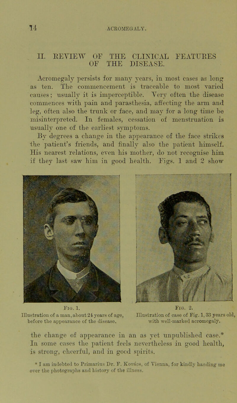 II. REVIEW OF THE CLIXICAL FEATURES OF THE DISEASE. Acromegaly persists for mam* years, in most cases as long as ten. The commencement is traceable to most varied causes; usually it is imperceptible. Very often the disease commences vith pain and parasthesia, affecting the arm and leg, often also the trunk or face, and may for a long time be misinterpreted. In females, cessation of menstruation is usually one of the earliest symptoms. Hy degrees a change in the appearance of the face strikes the patient’s Mends, and finally also the patient himself. His nearest relations, even his mother, do not recognise him if they last saw him in good health. Figs. 1 and 2 show Fig. 1. Fig. 2. Illustration of a man, about 21 years of age, Illustration of case of Fig. 1,33 years old, before the appearance of the disease. with well-marked acromegaly. the change of appearance in an as yet unpublished case.* Ill some cases the patient feels nevertheless in good health, is strong, cheerful, and in good .spirits. * I am indebted to Primarius Dr. F. Koviics, of Vienna, for kindly handing mo over the photographs and history of the illness.