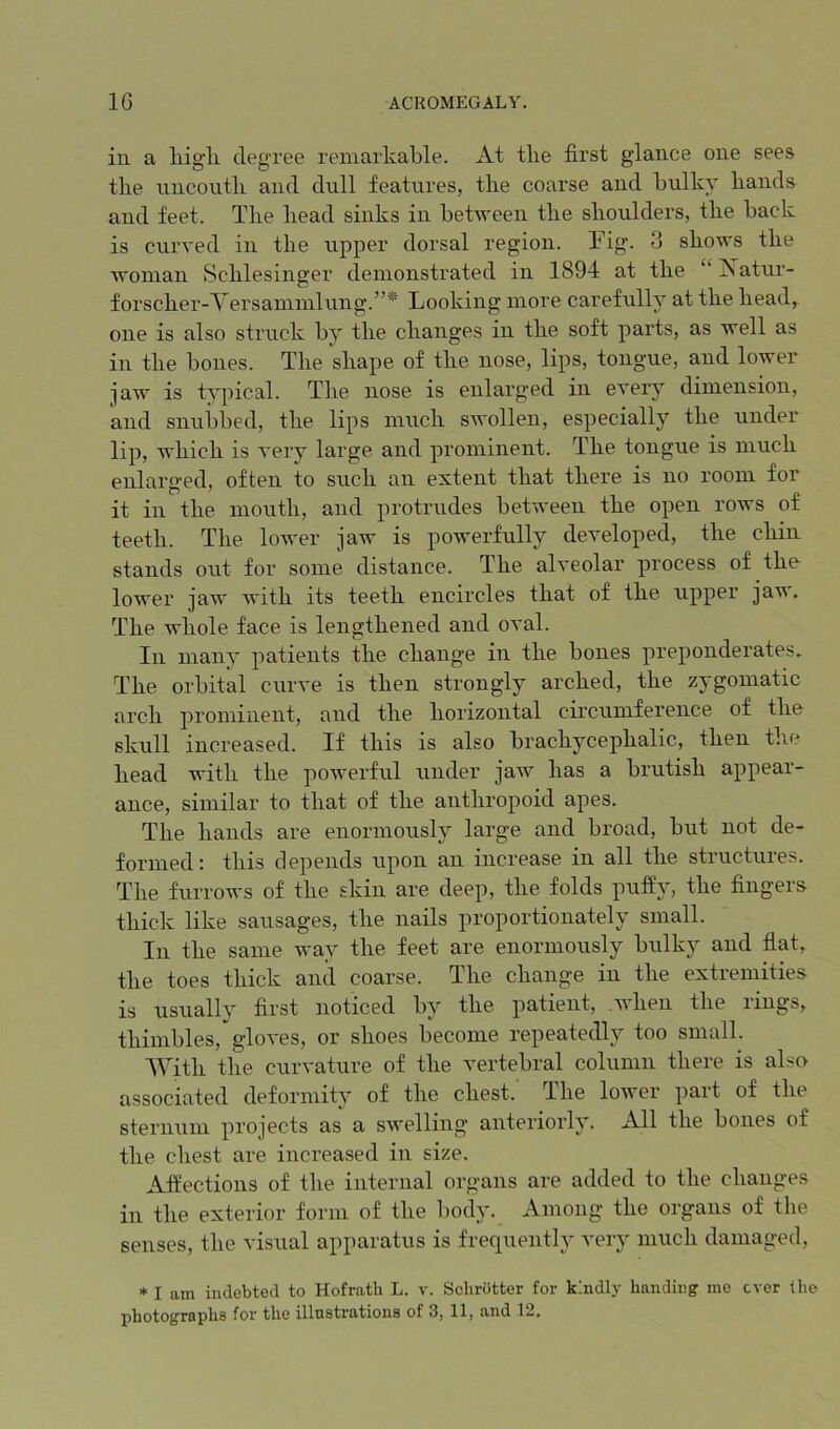 ill a liigli degree remarkable. At tlie first glance one sees the nncontli and dull features, the coarse and bulky hands and feet. The head sinks in between the shoulders, the back is curved in the upper dorsal region. Fig. 3 shows the woman Schlesinger demonstrated in 1894 at the ‘ Aatur- forscher-Versammlung.”* Looking more carefully at the head, one is also struck by the changes in the soft parts, as well as in the bones. The shape of the nose, lips, tongue, and lower jaw is typical. The nose is enlarged in eveiy dimension, and snubbed, the lips much swollen, especially the under lip, which is very large and prominent. The tongue is much enlarged, often to such an extent that there is no room for it in the month, and protrudes between the open rows of teeth. The lower jaw is powerfully developed, the cliin stands out for some distance. The alveolar process of the- lower jaw with its teeth encircles that of the upper jaw. The whole face is lengthened and oval. In many patients the change in the bones preponderates. The orbital curve is then strongly arched, the zygomatic arch prominent, and the horizontal circumference of the skull increased. If this is also brachycephalic, then the head with the powerful under jaw has a brutish appear- ance, similar to that of the anthropoid apes. The hands are enormously large and broad, but not de- formed: this depends upon an increase in all the structures. The furrows of the skin are deep, the folds pufty, the fingers thick like sausages, the nails proportionately small. In the same way the feet are enormously bulky and flat, the toes thick and coarse. The change in the extremities is usually first noticed by the patient, when the rings, thimbles, gloves, or shoes become repeatedly too small. With the curvature of the vertebral column there is also associated deformity of the chest. The lower part of the sternum projects as a swelling anteriorly. All the bones of the chest are increased in size. Affections of the internal organs are added to the changes in the exterior form of the body. Among the organs of the senses, the visual apparatus is frequently very much damaged, * I am indebted to Hofrath L. v. Schrotter for kindly handing me ever the photographs for the illustrations of 3, 11, and 12.