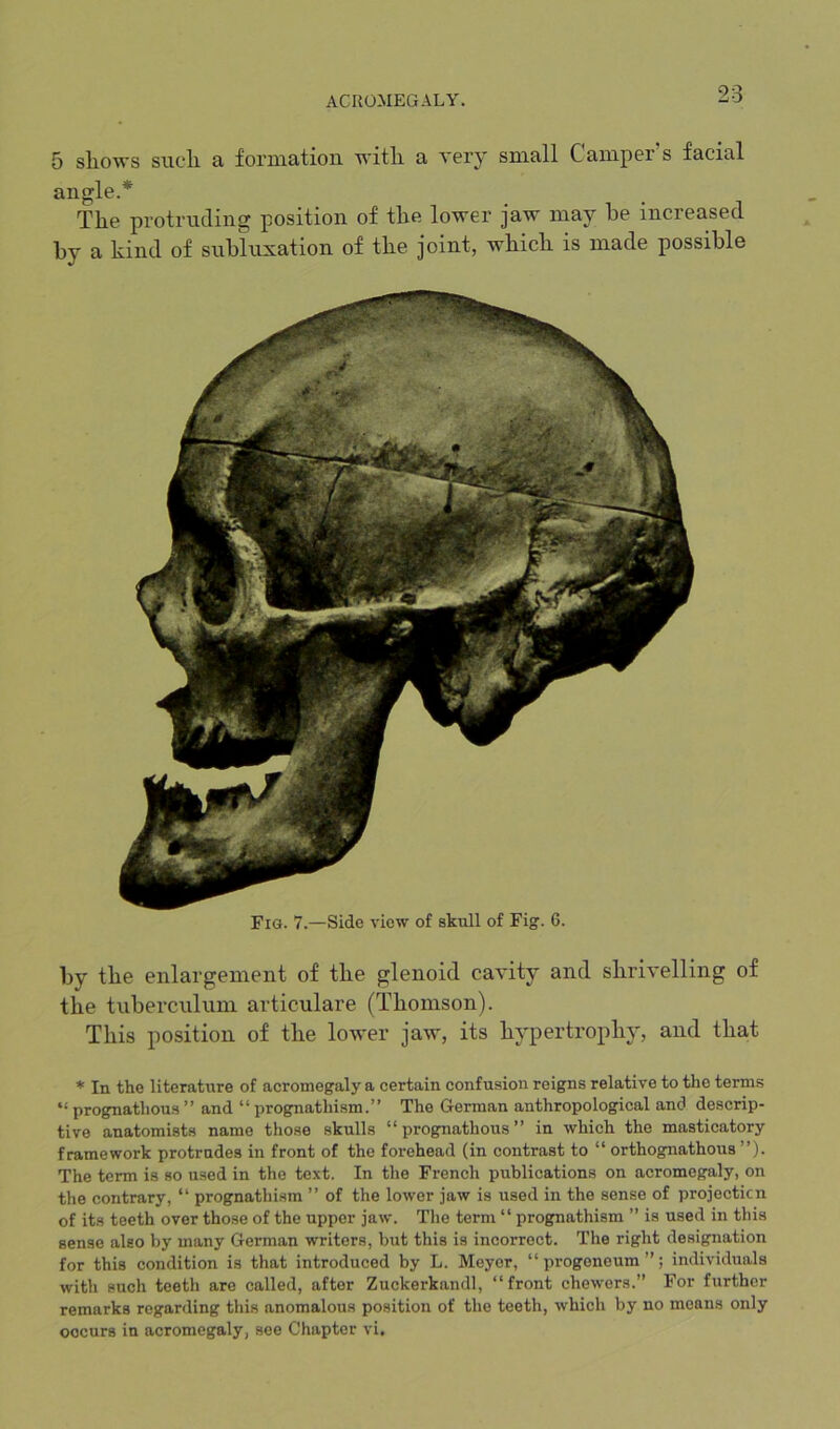 5 sliows such a formation with a verj' small Camper’s facial angle.* The protruding position of the lower jaw may he increased by a kind of subluxation of the joint, which is made possible Fig. 7.—Side view of skull of Fig. 6. by the enlargement of the glenoid cavity and shrivelling of the tuberculum articulare (Thomson). This position of the lower jaw, its hypertrophy, and that * In the literature of acromegaly a certain confusion reigns relative to the terms “ prognathous ” and “ prognathism.” The German anthropological and descrip- tive anatomists name those skulls “prognathous” in which the masticatory framework protrudes in front of the forehead (in contrast to “ orthognathous ”). The term is so used in the text. In the French publications on acromegaly, on the contrary, “ prognathism ” of the lower jaw is used in the sense of projecticn of its teeth over those of the upper jaw. The term “ prognathism ” is used in this sense also by many German writers, but this is incorrect. The right designation for this condition is that introduced by L. Meyer, “ progeneum ”; individuals with such teeth are called, after Zuckerkandl, “front chewers.” For further remarks regar<ling this anomalous position of the teeth, which by no means only occurs iu acromegaly, see Chapter vi.