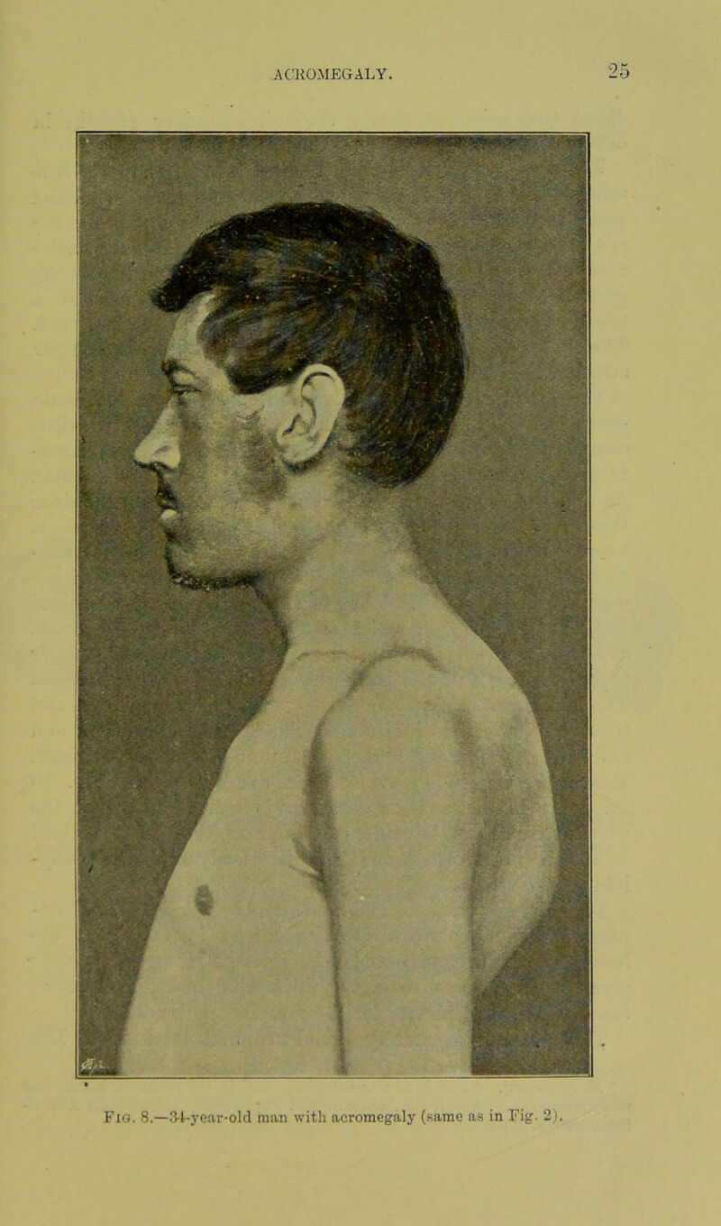 Fio. 8.—3-Lyear-olcl man with acromegaly (same as in Fig. 2)