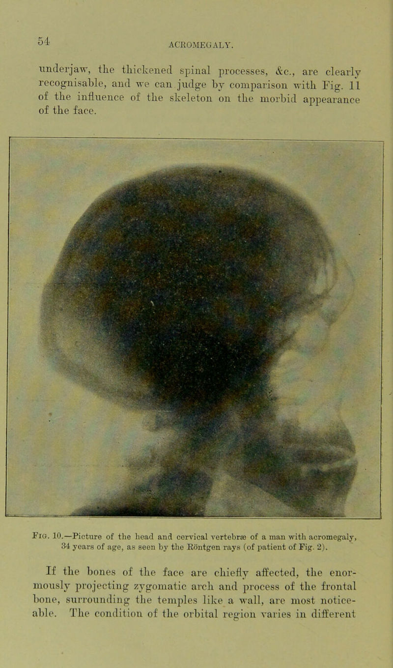 acuomp:galv. imderjaw, the tliickeued spinal processes, &c., are clearly recognisable, and we can judge by comparison with Fig. 11 of the influence of the skeleton on tbe morbid appearance of tbe face. Fia. 10.—Picture of tlie head and cervical vertebras of a man with acromegal5', 34 years of age, as seen by the Eiintgen rays (of patient of Fig. 2). If tbe bones of tbe face are cbiefiy affected, tbe enor- mously projecting zygomatic arcb and process of tbe frontal bone, surrounding tbe temples like a wall, are most notice- able. Tbe condition of tbe orbital region varies in different