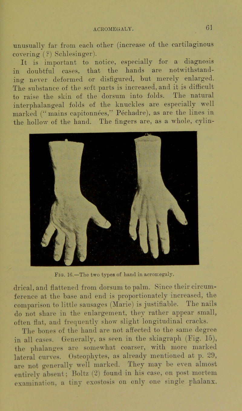 muisually far from eacK other (increase of the cartilaginous covering (?) Schlesinger). It is important to notice, especially for a diagnosis in doubtful cases, that the hands are notwithstand- ing never deformed or disfigured, hut merely enlarged. The substance of the soft parts is increased, and it is difficult to raise the skin of the dorsum into folds. The natural interphalangeal folds of the knuckles are especially well marked (‘‘mains capitonnees,” Pechadre), as are the lines in the hollow of the hand. The fingers are, as a whole, cylin- Fig. 1G.—The two types of hand in acromegaly. drical, and flattened from dorsum to palm. Since their circum- ference at the base and end is proportionately increased, the comparison to little sausages (Marie) is justifiable. The nails do not share in the enlargement, they rather appear small, often fiat, and frequently show slight longitudinal cracks. Tlie bones of the hand are not affected to the same degree in all cases. Generally, as seen in the skiagraph (Fig. 15), the phalanges are somewhat coarser, with more marked lateral curves. Osteophytes, as already mentioned at p. 29, are not generally well marked. They may be even almost entirely absent; Holtz (2) found in his case, on post mortem examination, a tiny exostosis on only one single phalanx.