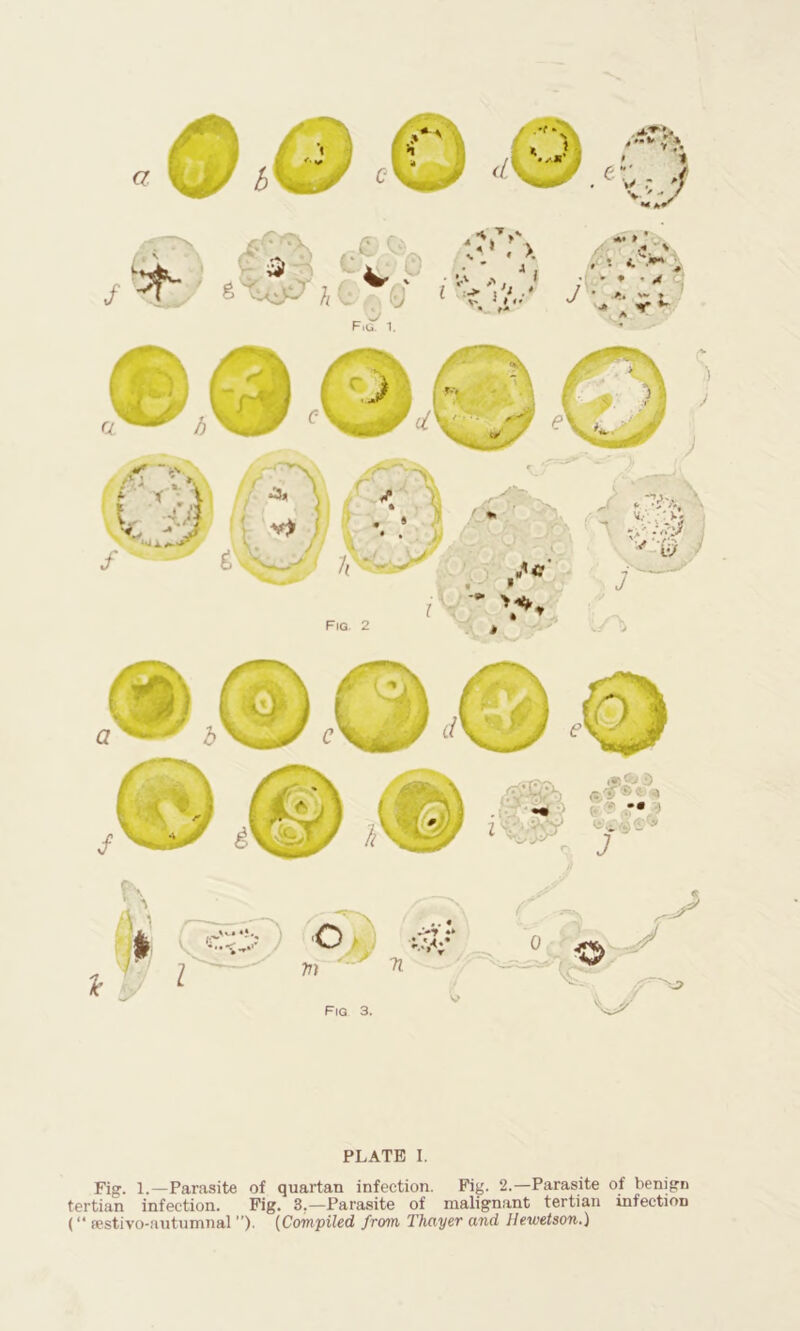 PLATE I. Fig. 1. —Parasite of quartan infection. Fig. 2.—Parasite of benign tertian infection. Fig. 3.—Parasite of malignant tertian infection (“ sestivo-autumnal ”). (Compiled from Thayer and Hewetson.)