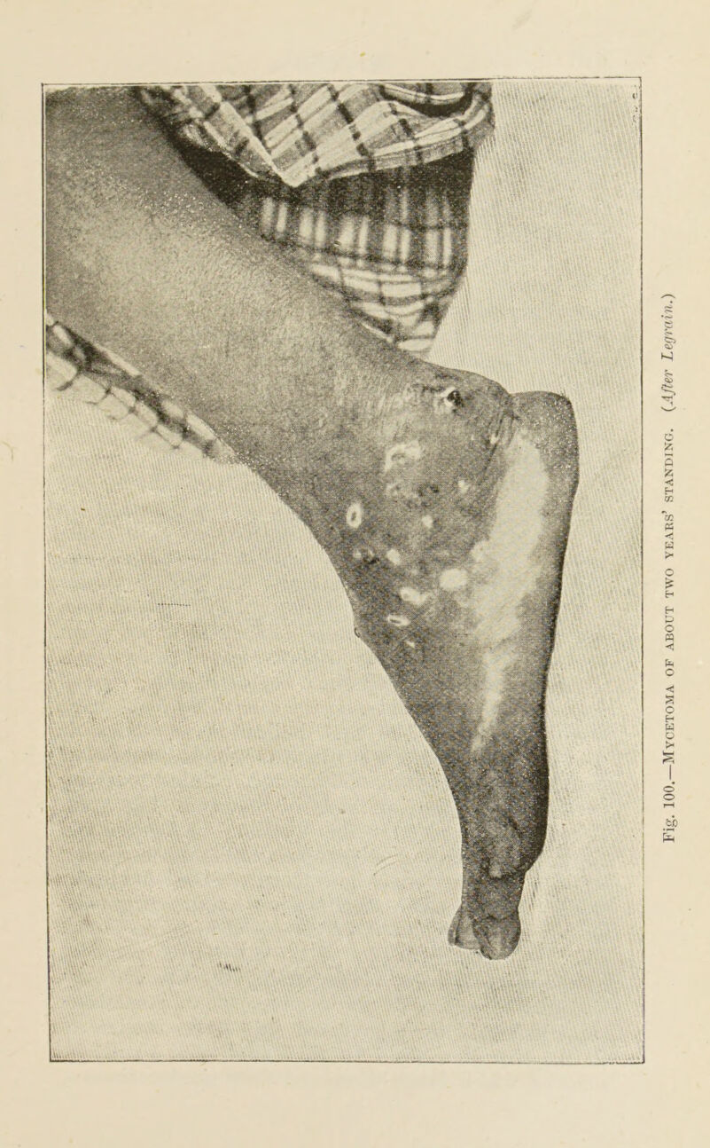 Fig. 100.—Mycetoma of about two years’ standing. (After Legrain.)