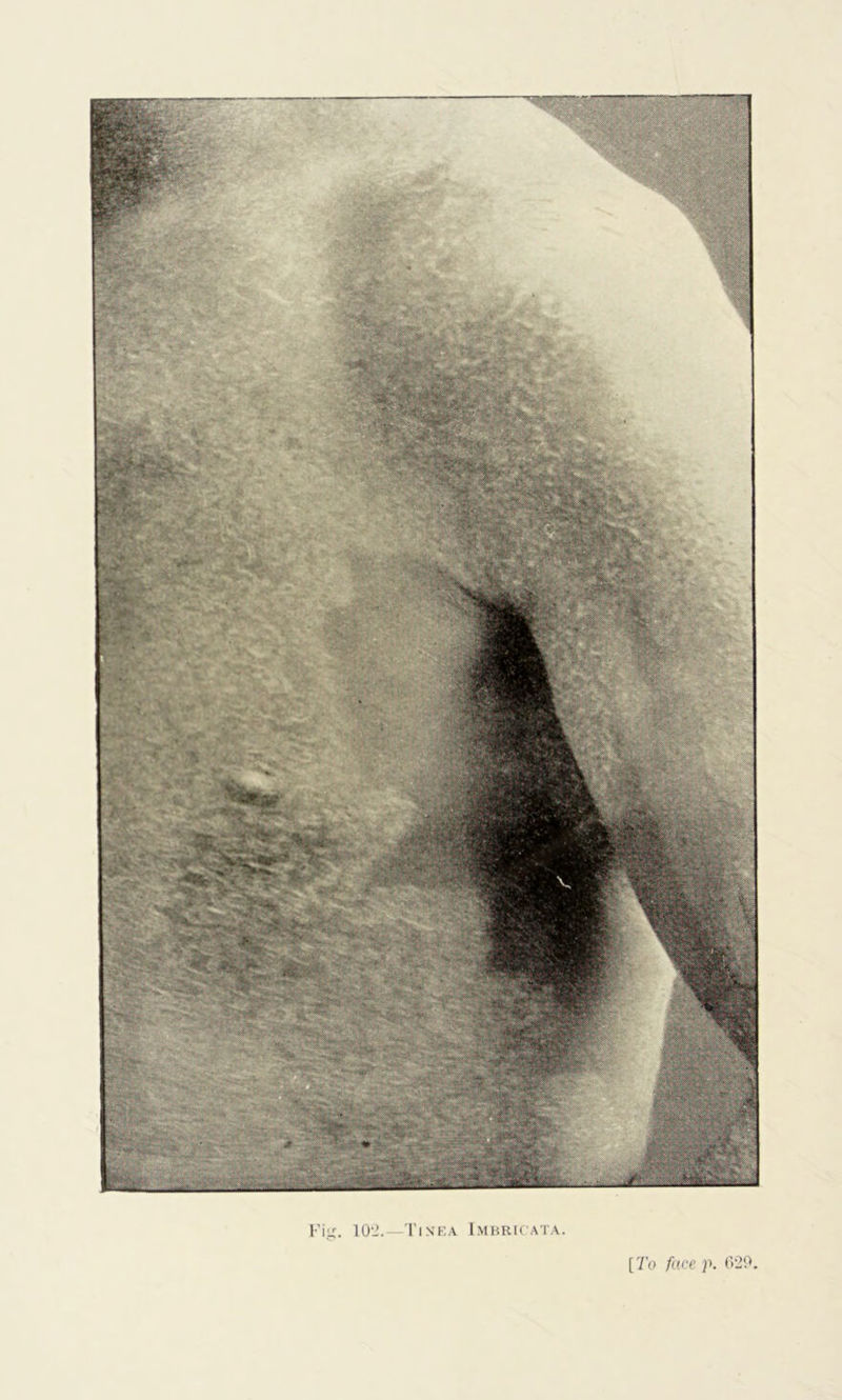 Fig. 10'2. -Tinea Imbricata. [To face p. 629,