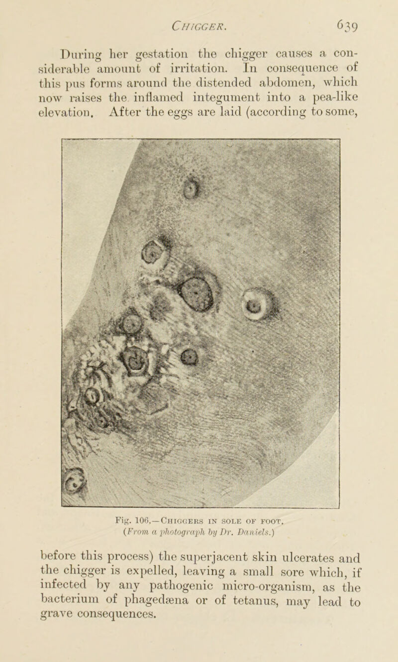 During: her gestation the chigger causes a con- siderable amount of irritation. In consequence ot this pus forms around the distended abdomen, which now raises the inflamed integument into a pea-like elevation. After the eggs are laid (according to some, Fig. 106.—Chiggers in sole of foot. (From a photograph by Dr. Daniels.) before this process) the superjacent skin ulcerates and the chigger is expelled, leaving a small sore which, if infected by any pathogenic micro-organism, as the bacterium of phagedsena or of tetanus, may lead to grave consequences.