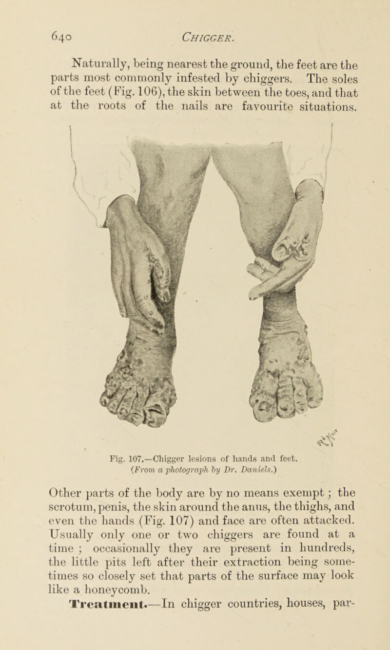 Fig. 107.—Chigger lesions of hands and feet. {From a photograph by Dr. Daniels.) Other parts of the body are by no means exempt; the scrotum, penis, the skin around the anus, the thighs, and even the hands (Fig. 107) and face are often attacked. Usually only one or two chiggers are found at a time ; occasionally they are present in hundreds, the little pits left after their extraction being some- times so closely set that parts of the surface may look like a honeycomb. Treatment.—In chigger countries, houses, par- Naturally, being nearest the ground, the feet are the parts most commonly infested by chiggers. The soles of the feet (Fig. 106), the skin between the toes, and that at the roots of the nails are favourite situations.