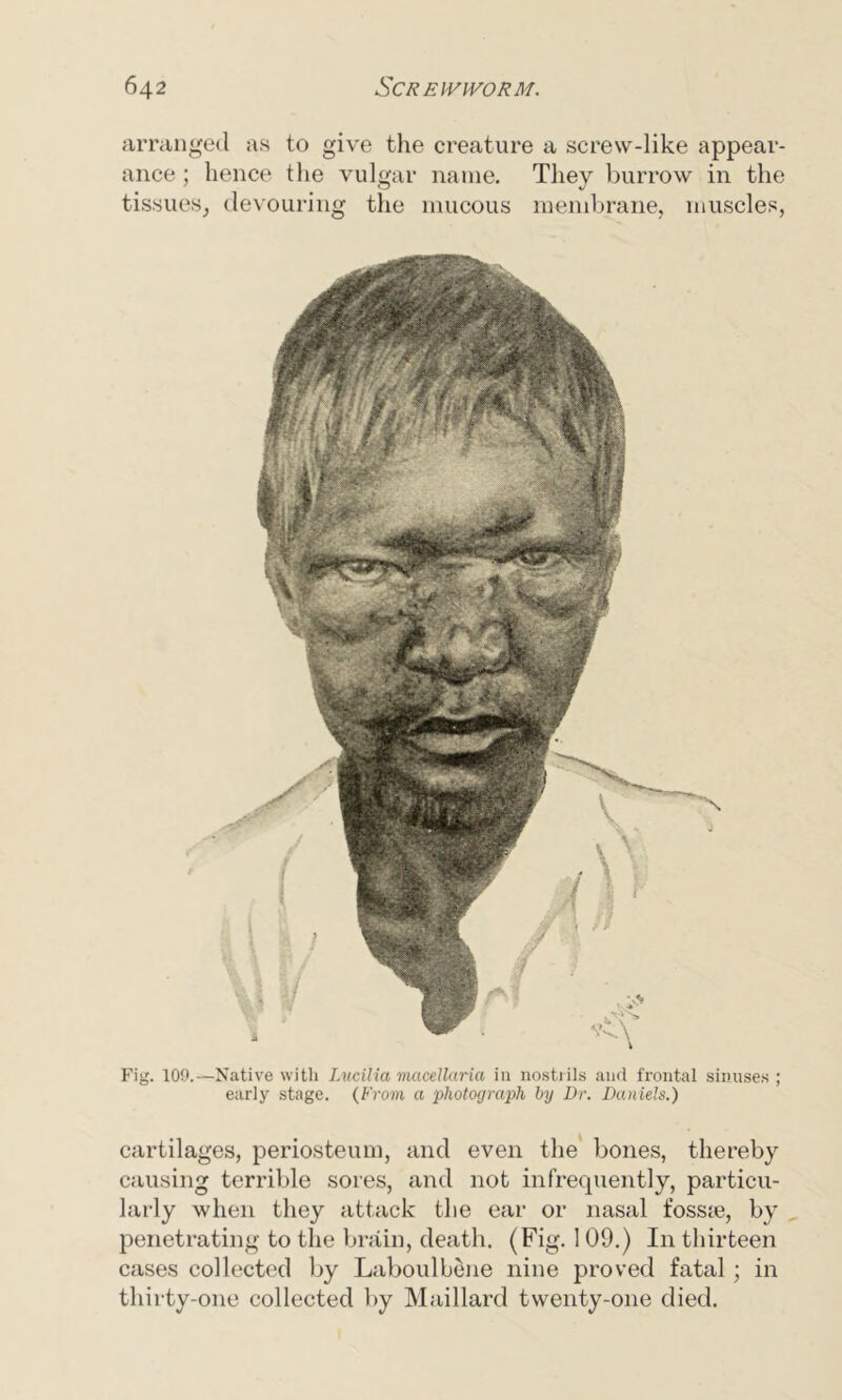 arranged as to give the creature a screw-like appear- ance ; hence the vulgar name. They burrow in the tissues, devouring the mucous membrane, muscles, cartilages, periosteum, and even the bones, thereby causing terrible sores, and not infrequently, particu- larly when they attack the ear or nasal fossie, by penetrating to the brain, death. (Fig. 109.) I11 thirteen cases collected by Laboulbene nine proved fatal; in thirty-one collected by Maillard twenty-one died. Fig. 109.—Native with Lucilia maoeUaria in nostrils and frontal sinuses ; early stage. (From a photograph by Dr. Daniels.)