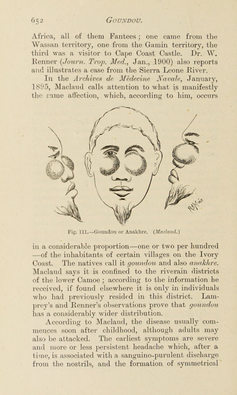 Africa, all of them Fantees; one came from the Wassail territory, one from the Gamin territory, the third was a visitor to Cape Coast Castle. Dr. W. Renner (Journ. Trop. Mecl., Jan., 1900) also reports and illustrates a case from the Sierra Leone River. In the Archives de Medecine Navals, January, 1895, Maclaud calls attention to what is manifestly the same affection, which, according to him, occurs Fig. 111.—Goundou or Anaklire. (Maclattd.) in a considerable proportion—one or two per hundred —of the inhabitants of certain villages on the Ivory Coast. The natives call it goundou and also anaklire. Maclaud says it is confined to the riverain districts of the lower Camoe ; according to the information he received, if found elsewhere it is only in individuals who had previously resided in this district. Lam- prey’s and Renner’s observations prove that goundou has a considerably wider distribution. According to Maclaud, the disease usually com- mences soon after childhood, although adults may also be attacked. The earliest symptoms are severe and more or less persistent headache which, after a time, is associated with a sanguino-purulent discharge from the nostrils, and the formation of symmetrical