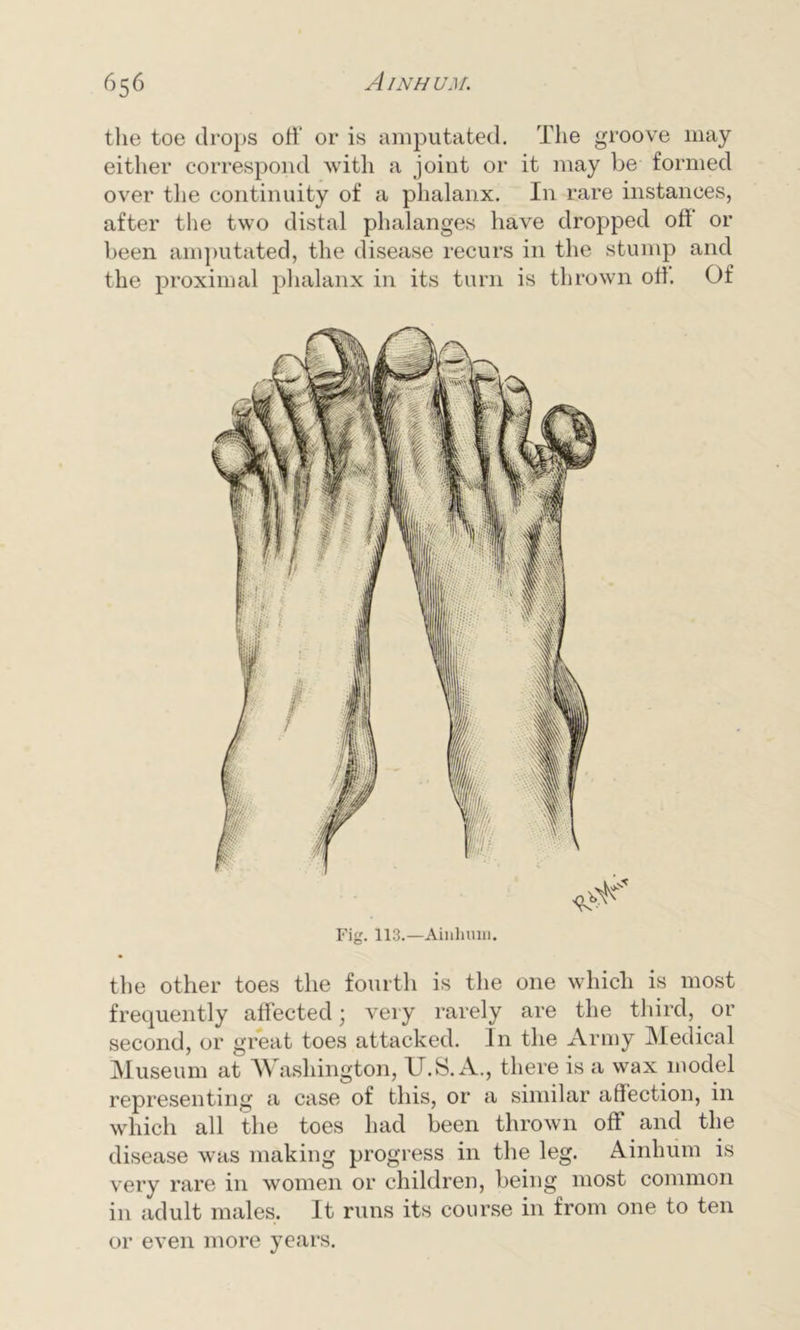 the toe drops off or is amputated. The groove may either correspond with a joint or it may be formed over the continuity of a phalanx. In rare instances, after the two distal phalanges have dropped oft or been amputated, the disease recurs in the stump and the proximal phalanx in its turn is thrown oh. Of Fig. 113.—Ainhum. the other toes the fourth is the one which is most frequently affected; very rarely are the third, or second, or great toes attacked. In the Army Medical Museum at Washington, U.S.A., there is a wax model representing a case of this, or a similar affection, in which all the toes had been thrown off and the disease was making progress in the leg. Ainhum is very rare in women or children, being most common in adult males. It runs its course in from one to ten or even more years.