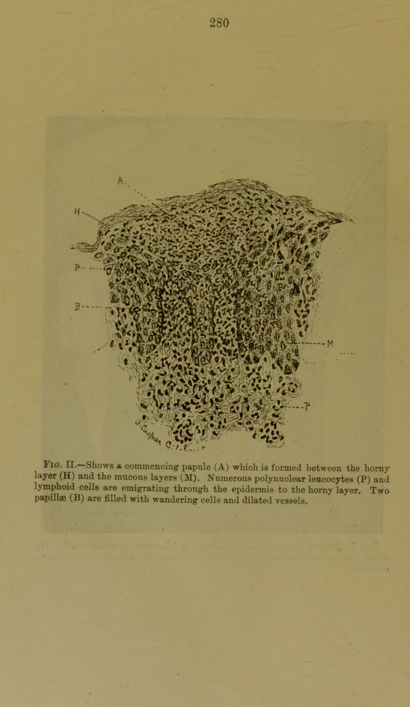 Fig. II. Shows a commencing papule (A) which is formed betwoen the horny layer (H) and the mucous layers (M). Numerous polynuclear leucocytes (P) and lymphoid cells are emigrating through the epidermis to the horny layer. Two papillae (B) are filled with wandering cells and dilated vessels.