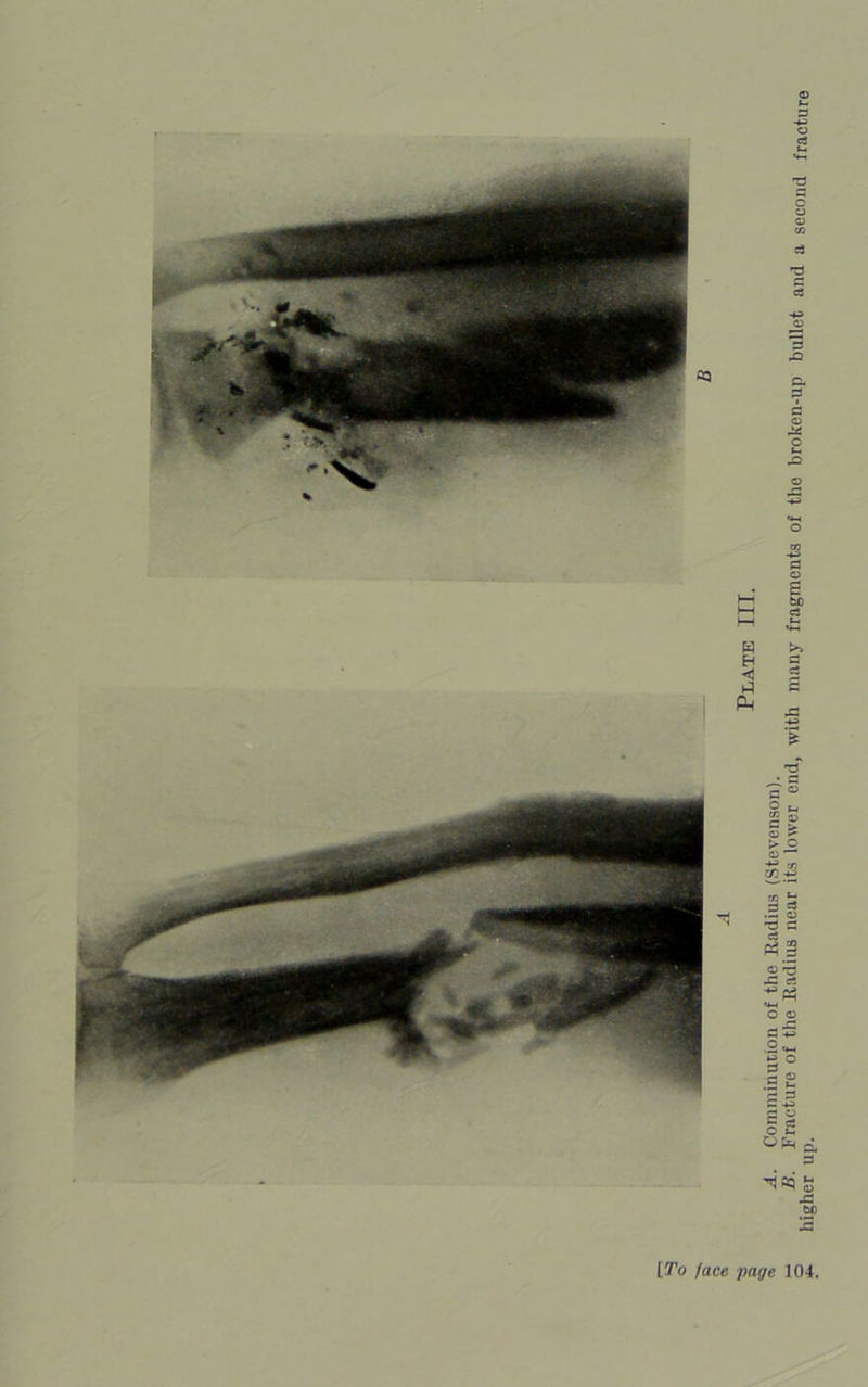 Comminution of the Radius (.Stevenson).