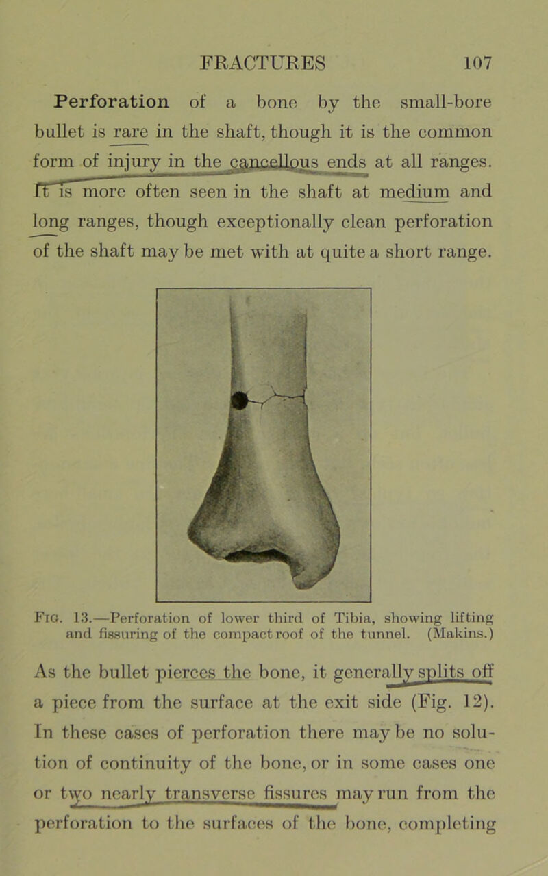 Perforation of a bone by the small-bore bullet is rare in the shaft, though it is the common medium and long ranges, though exceptionally clean perforation of the shaft may be met with at quite a short range. Fio. 1.3.—Perforation of lower tliird of Tibia, showing lifting and fissuring of the com^Jactroof of the tunnel. (Makins.) a piece from the surface at the exit side (Fig. 12). In these cases of perforation there maybe no solu- tion of continuity of the bone, or in some cases one or two nearly transverse fissures may run from the pt'rforation to the surfaces of the bone, completing [US ends at all ranges. As the bullet pierces the bone, it generally splits off