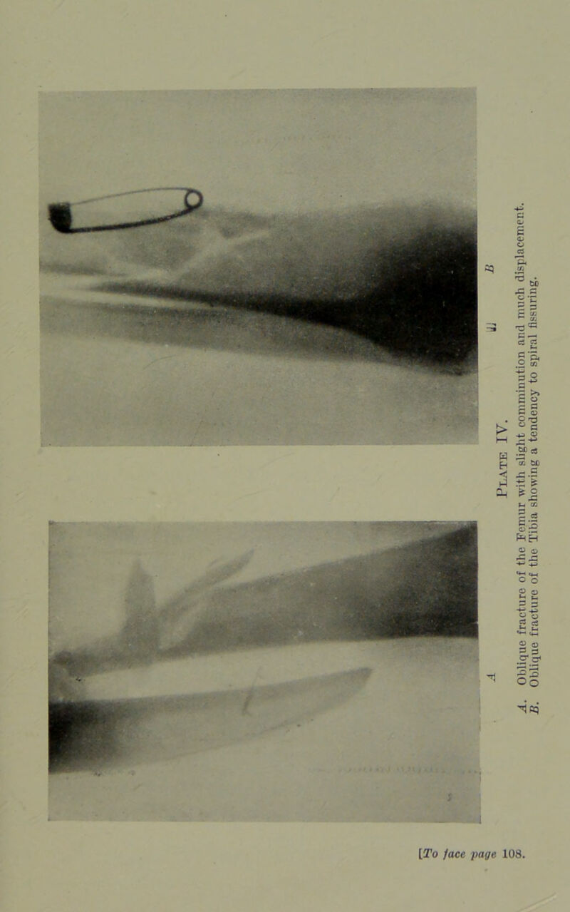 Plate IV. Oblique fracture of the Femur with slight comminution and much displacement. Oblique fracture of the Tibia showing a tendency to spiral Assuring.