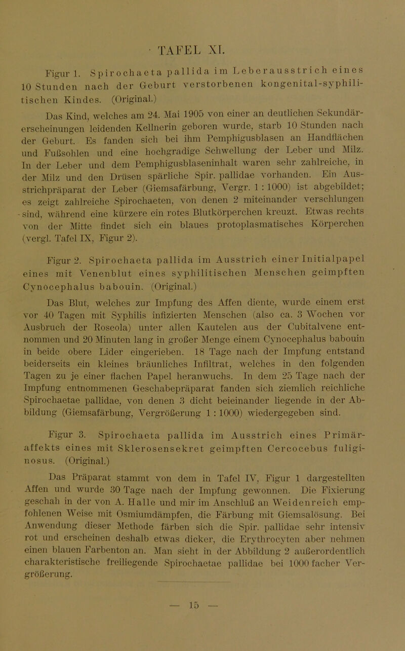 Figur l. Spirochaeta pallida im Leberausstrich eines 10 Stunden nach der Geburt verstorbenen kongenital-syphili- tischen Kindes. (Original.) Das Kind welches am 24. Mai 1905 von einer an deutlichen Sekundär- erscheinungen leidenden Kellnerin geboren wurde, staib 10 Stunden nach der Geburt, Es fanden sich bei ihm Pemphigusblasen an Handflächen und Fußsohlen und eine hochgradige Schwellung dei Lebei und Milz. In der Leber und dem Pemphigusblaseninhalt waren sehi zahlreiche, in der Milz und den Drüsen spärliche Spir. pallidae vorhanden. Ein Aus- strichpräparat der Leber (Giemsafärbung, Vergr. 1 : 1000) ist abgebildet, es zeigt zahlreiche Spirochaeten, von denen 2 miteinander verschlungen - sind, während eine kürzere ein rotes Blutkörperchen kreuzt. Etwas rechts von der Mitte findet sich ein blaues protoplasmatisches Körperchen (vergl. Tafel IX, Figur 2). Figur 2. Spirochaeta pallida im Ausstrich einer Initialpapel eines mit Venenblut eines syphilitischen Menschen geimpften Cynocephalus babouin. (Original.) Das Blut, welches zur Impfung des Affen diente, wurde einem erst vor 40 Tagen mit Syphilis infizierten Menschen (also ca. 3 Wochen vor Ausbruch der Boseola) unter allen Kautelen aus der Cubitalvene ent- nommen und 20 Minuten lang in großer Menge einem Cynocephalus babouin in beide obere Lider eingerieben. 18 Tage nach der Impfung entstand beiderseits ein kleines bräunliches Infiltrat, welches in den folgenden Tagen zu je einer flachen Papel heran wuchs. In dem 25 Tage nach der Impfung entnommenen Geschabepräparat fanden sich ziemlich reichliche Spirochaetae pallidae, von denen 3 dicht beieinander liegende in der Ab- bildung (Giemsafärbung, Vergrößerung 1 : 1000) wiedergegeben sind. Figur 3. Spirochaeta pallida im Ausstrich eines Primär- affekts eines mit Sklerosensekret geimpften Cercocebus fuligi- nosus. (Original.) Das Präparat stammt von dem in Tafel IV, Figur 1 dargestellten Affen und wurde 30 Tage nach der Impfung gewonnen. Die Fixierung geschah in der von A. Halle und mir im Anschluß an Weidenreich emp- fohlenen Weise mit Osmiumdämpfen, die Färbung mit Giemsalösung. Bei Anwendung dieser Methode färben sich die Spir. pallidae sehr intensiv rot und erscheinen deshalb etwas dicker, die Erythrocyten aber nehmen einen blauen Farbenton an. Man sieht in der Abbildung 2 außerordentlich charakteristische freiliegende Spirochaetae pallidae bei 1000 facher Ver- größerung.