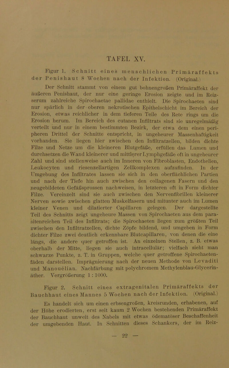 Figur 1. Schnitt eines menschlichen Primäraffekts der Penis haut 8 Wochen nach der Infektion. (Original.) Der Schnitt stammt von einem gut bohnengroßen Primäraffekt der äußeren Penishaut, der nur eine geringe Erosion zeigte und im Reiz- serum zahlreiche Spirochaetae pallidae enthielt. Die Spirochaeten sind nur spärlich in der oberen nekrotischen Epithelschicht im Bereich der Erosion, etwas reichlicher in dem tieferen Teile des Rete rings um die Erosion herum. Im Bereich des cutanen Infiltrats sind sie unregelmäßig verteilt und nur in einem bestimmten Bezirk, der etwa dem einen peri- pheren Drittel der Schnitte entspricht, in ungeheurer Massenhaftigkeit vorhanden. Sie liegen hier zwischen den Infiltratzellen, bilden dichte Filze und Metze um die kleineren Blutgefäße, erfüllen das Lumen und durchsetzen die Wand kleinerer und mittlerer Lymphgefäße oft in ungeheurer Zahl und sind stellenweise auch im Inneren von Fibroblasten, Endothelien, Leukocyten und riesenzellartigen Zellkomplexen aufzufinden, ln der Umgebung des Infiltrates lassen sie sich in den oberflächlichen Partien und nach der Tiefe hin auch zwischen den collagenen Fasern und den neugebildeten Gefäßsprossen nachweisen, in letzteren oft in Form dichter Filze. Vereinzelt sind sie auch zwischen den Nervenfibrillen kleinerer Nerven sowie zwischen glatten Muskelfasern und mitunter auch im Lumen kleiner Venen und dilatierter Capillaren gelegen. Der dargestellte Teil des Schnitts zeigt ungeheure Massen von Spirochaeten aus dem para- sitenreichen Teil des Infiltrats; die Spirochaeten liegen zum größten Teil zwischen den Infiltratzellen, dichte Zöpfe bildend, und umgeben in Form dichter Filze zwei deutlich erkennbare Blutcapillaren, von denen die eine längs, die andere quer getroffen ist. An einzelnen Stellen, z. B. etwas oberhalb der Mitte, liegen sie auch intracellulär; vielfach sieht man schwarze Punkte, z. T. in Gruppen, welche quer getroffene Spirochaeten- fäden darstellen. Imprägnierung nach der neuen Methode von Levaditi und Manouelian. Nachfärbung mit polychromem Methylenblau-Glycerin- äther. Vergrößerung 1 : 1000. Figur 2. Schnitt eines extragenitalen Primäraffekts der Bauchhaut eines Mannes 5 Wochen nach der Infektion. (Original.) Es handelt sich um einen erbsengroßen, kreisrunden, erhabenen, auf der Höhe erodierten, erst seit kaum 2 Wochen bestehenden Primäraffekt der Bauchhaut unweit des Nabels mit etwas ödematöser Beschaffenheit der umgebenden Haut. In Schnitten dieses Schankers, der im Reiz-