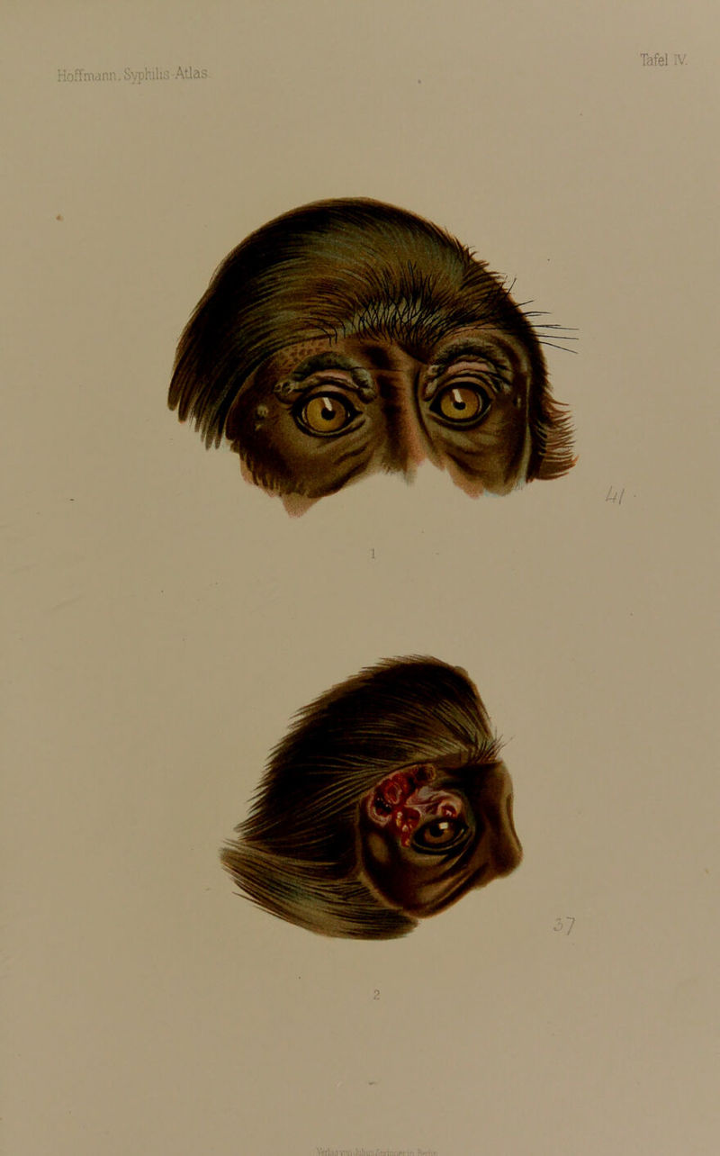 Hoffmann, Syphilis - Atlas. l 2 Yerlaüvnn Julius Snrfnrjpy:-, ftohn