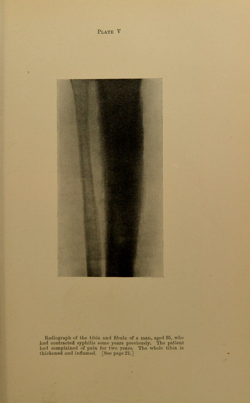 Radiograph of the til)ia and fibula of a man, aged 35, who had contracted syphilis some years previously. The patient had complained of pain for two years. The whole tibia is thickened and inflamed. [See i)age21.]