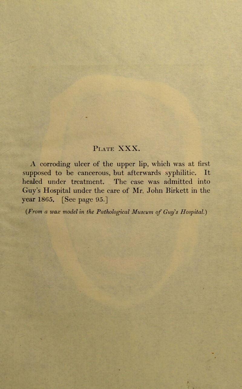 A corroding ulcer of the upper lip, which was at first supposed to be caneerous, but afterwards syphilitic. It healed under treatment. The case was admitted into Guy’s Hospital under the care of Mr. John Birkett in the year 1865. [See page 95.]