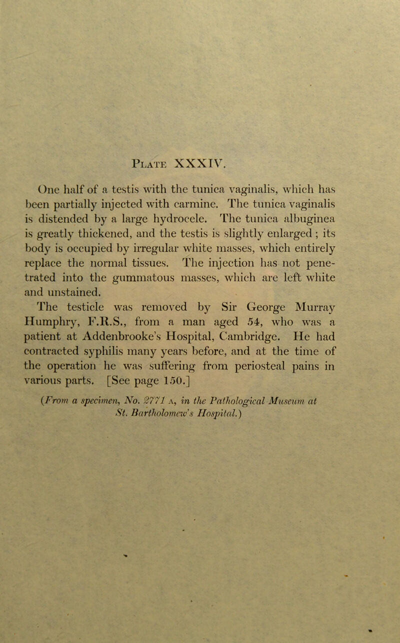 One half of a testis with the tuniea vaginalis, which has been partially injected with carmine. The tunica vaginalis is distended by a large hydrocele. The tunica albuginea is greatly thickened, and the testis is slightly enlarged ; its body is occupied by irregular white masses, which entirely replace the normal tissues. The injection has not pene- trated into the gummatous masses, which are left white and unstained. The testicle was removed by Sir George Murray Humphry, F.R.S., from a man aged 54, who was a patient at Addenbrooke’s Hospital, Cambridge. He had contracted syphilis many years before, and at the time of the operation he was suffering from periosteal pains in various parts. [See page 150.] {From a specimen, No. ^771 a, in the Pathological Museum at St. Bartholomexv s Plospital.)