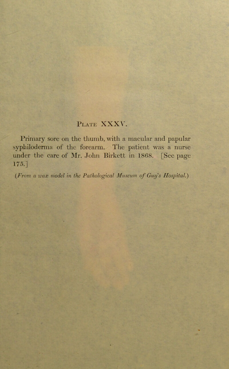 1^’irnary sore on the thumb, with a macular and papular syphiloderma of the forearm. The patient was a nurse under the care of Mr. John Birkett in 1868. [See page 175.] {From a xvax model in the Pathological Museum of Guy's Hospital,)