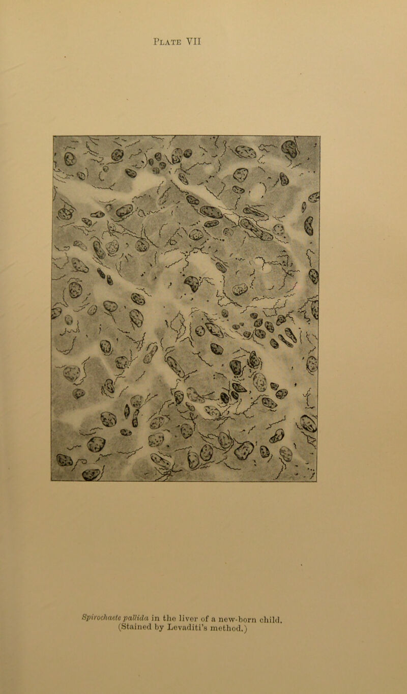 Spirochaete paUida in tlie liver of a new-born child. (Stained by Levaditi’s method.)