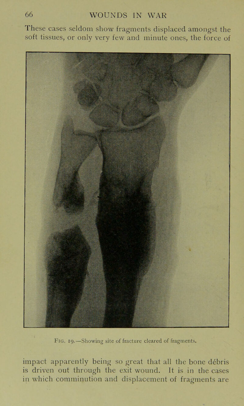 These cases seldom show fragments displaced amongst the soft tissues, or only very few and minute ones, the force of Fig. 19.—Sliowing site of fracture cleared of fragments. impact apparently being so great that all the bone debris is driven out through the exit wound. It is in the cases in which comminution and displacement of fragments are