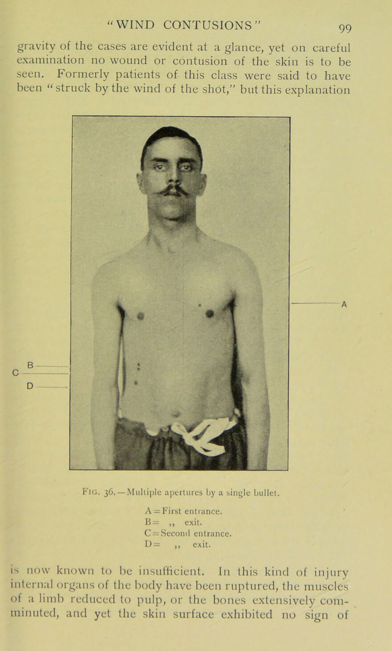 gravity of the cases are evident at a glance, yet on careful examination no wound or contusion of the skin is to be seen. Formerly patients of this class were said to have been “struck by the wind of the shot,” but this explanation Fig. 36.—Multiple apertures by a single bullet. A = First entrance. B= ,, exit. C = .Second entrance. I)= ,, exit. is now known to be insulhcient. In this kind of injury internal organs of the body have been ruptured, the muscles of a limb reduced to pulp, or the bones extensively com- minuted, and yet the skin surface exhibited no sign of