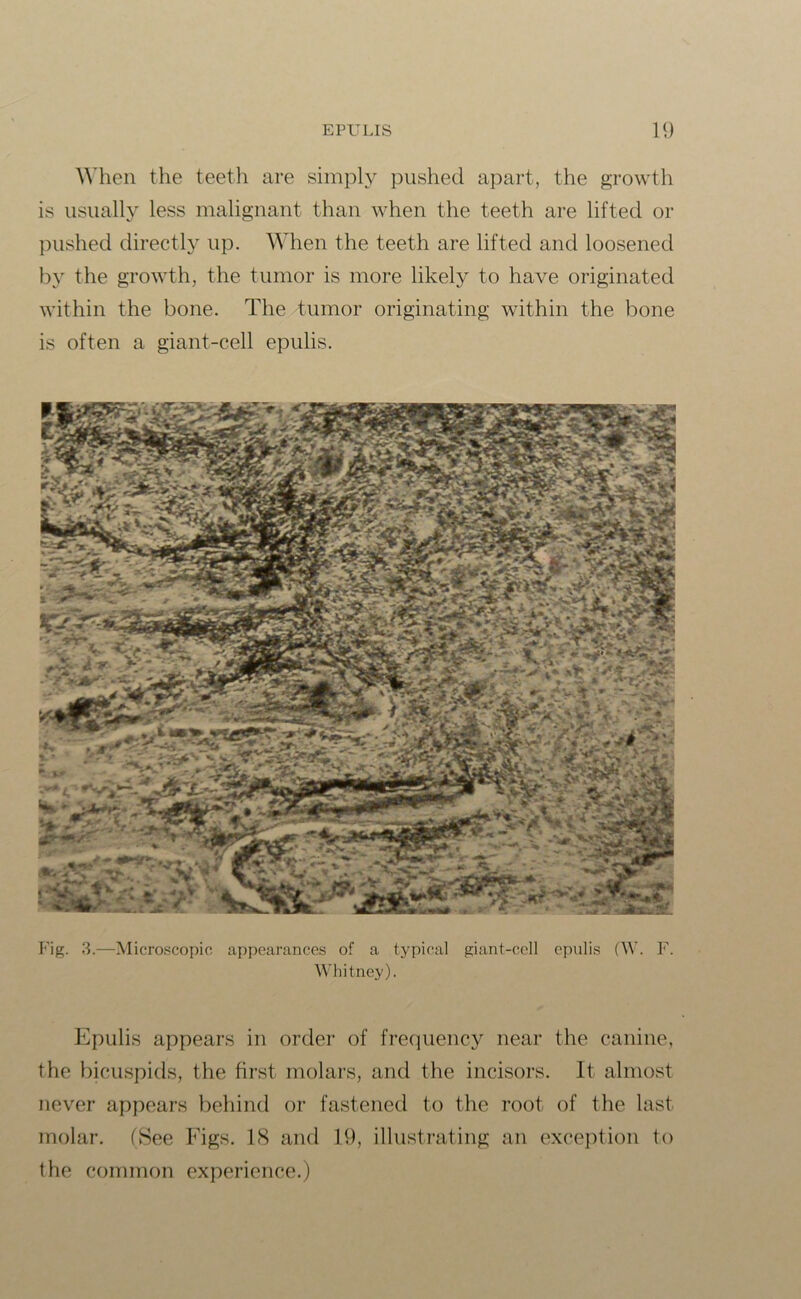 When the teeth are simply pushed apart, the growth is usually less malignant than when the teeth are lifted or pushed directly up. When the teeth are lifted and loosened by the growth, the tumor is more likely to have originated within the bone. The tumor originating within the bone is often a giant-cell epulis. Fig. 3.—Microscopic appearances of a typical giant-cell epulis (W. F. Whitney). Epulis appears in order of frequency near the canine, the bicuspids, the first molars, and the incisors. It almost never appears behind or fastened to the root of the last molar. (See Figs. 18 and 19, illustrating an exception to the common experience.)