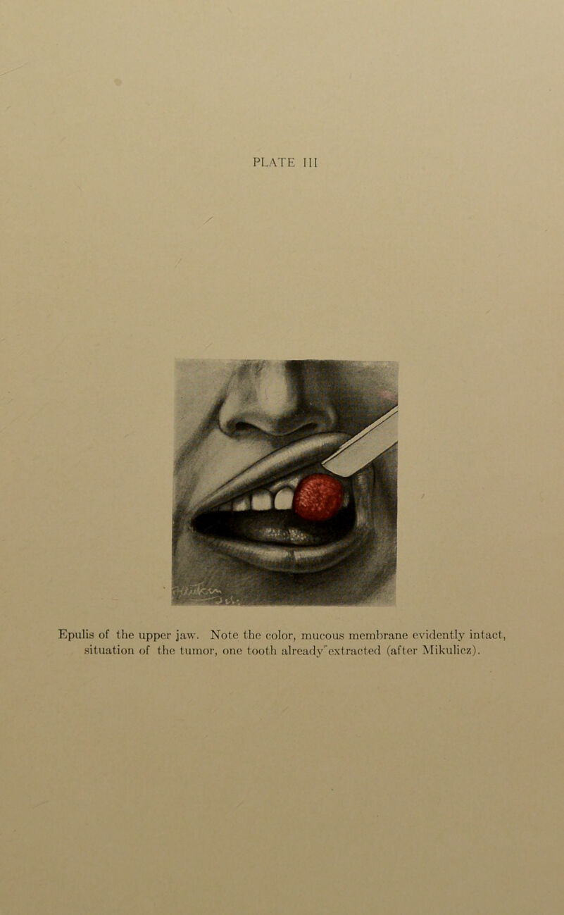 PLATE III Epulis of the upper jaw. Note the color, mucous membrane evidently intact, situation of the tumor, one tooth already1extracted (after Mikulicz).