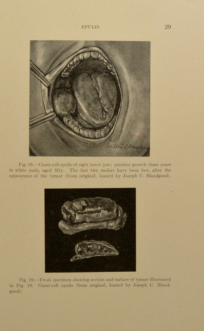 Fig. 18.—Giant-cell epulis of right lower jaw; painless growth three years in white male, aged fifty. The last two molars have been lost, after the appearance of the tumor (from original, loaned by Joseph C. Bloodgood). Fig. 10.—Fresh specimen showing section and surface of tumor illustrated in Fig. IS. Giant-cell epulis (from original, loaned by Joseph G. Blood- good).