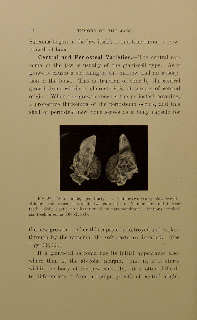 Sarcoma begins in the jaw itself; it is a true tumor or new- growth of bone. Central and Periosteal Varieties.—The central sar- coma of the jaw is usually of the giant-cell type. As it grows it causes a softening of the marrow and an absorp- tion of the bone. This destruction of bone by the central growth from within is characteristic of tumors of central origin. When the growth reaches the periosteal covering, a protective thickening of the periosteum occurs, and this shell of periosteal new bone serves as a bony capsule for Fig. 28.—White male, aged thirty-six. Tumor two years; slow growth, although the patient has made two cuts into it. Tumor surrounds incisor teeth. Soft, elastic, no ulceration of mucous membrane. Sections: typical giant-cell sarcoma (Bloodgood). the new-growth. After this capsule is destroyed and broken through by the sarcoma, the soft parts are invaded. (See Figs. 32, 33.) If a giant-cell sarcoma has its initial appearance else- where than at the alveolar margin,—that is, if it starts within the body of the jaw centrally,—it is often difficult to differentiate it from a benign growth of central origin,