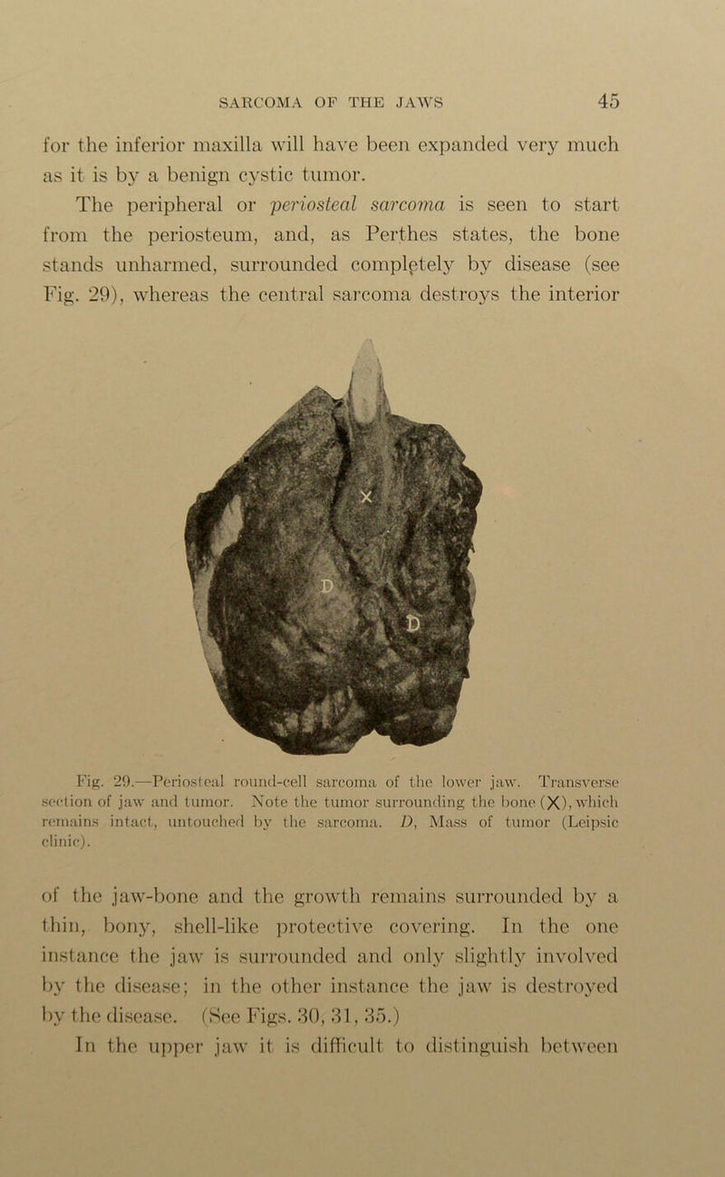 for the inferior maxilla will have been expanded very much as it is by a benign cystic tumor. The peripheral or periosteal sarcoma is seen to start from the periosteum, and, as Perthes states, the bone stands unharmed, surrounded completely by disease (see Fig. 29), whereas the central sarcoma destroys the interior Fig. 29.—Periosteal round-cell sarcoma of the lower jaw. Transverse section of jaw and tumor. Note the tumor surrounding the bone (X), which remains intact, untouched by the sarcoma. D, Mass of tumor (Leipsic clinic). of the jaw-bone and the growth remains surrounded by a thin, bony, shell-like protective covering. In the one instance the jaw is surrounded and only slightly involved by the disease; in the other instance the jaw is destroyed In the upper jaw it is difficult to distinguish between