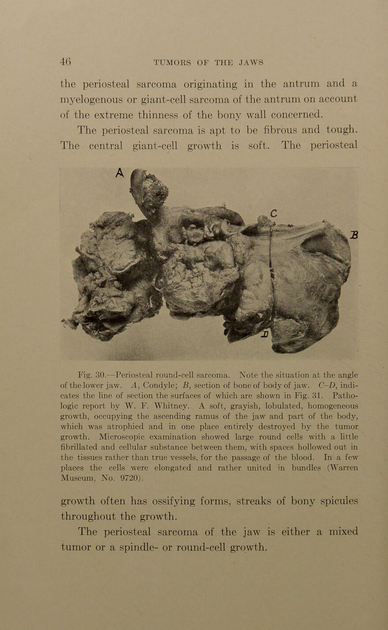 the periosteal sarcoma originating in the antrum and a myelogenous or giant-cell sarcoma of the antrum on account of the extreme thinness of the bony wall concerned. The periosteal sarcoma is apt to be fibrous and tough. The central giant-cell growth is soft. The periosteal Fig. 30.—Periosteal round-cell sarcoma. Note the situation at the angle of the lower jaw. A, Condyle; B, section of bone of body of jaw. C-D, indi- cates the line of section the surfaces of which are shown in Fig. 31. Patho- logic report by W. F. Whitney. A soft, grayish, lobulatecl, homogeneous growth, occupying the ascending ramus of the jaw and part of the body, which was atrophied and in one place entirely destroyed by the tumor growth. Microscopic examination showed large round cells with a little fibrillated and cellular substance between them, with spaces hollowed out in the tissues rather than true vessels, for the passage of the blood. In a few places the cells were elongated and rather united in bundles (Warren Museum, No. 9720). growth often has ossifying forms, streaks of bony spicules throughout the growth. The periosteal sarcoma of the jaw is either a mixed tumor or a spindle- or round-cell growth.