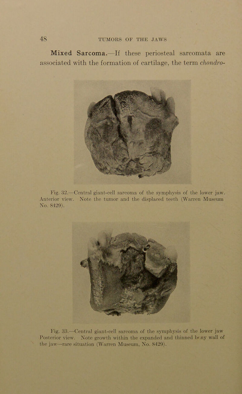 Mixed Sarcoma.—If these periosteal sarcomata are associated with the formation of cartilage, the term chondro- Fig. 32.—Central giant-cell sarcoma of the symphysis of the lower jaw. Anterior view. Note the tumor and the displaced teeth (Warren Museum No. S429). Fig. 33.—Central giant-cell sarcoma of the symphysis of the lower jaw Posterior view. Note growth within the expanded and thinned bony wall of the jaw—rare situation (Warren Museum, No. 8429).