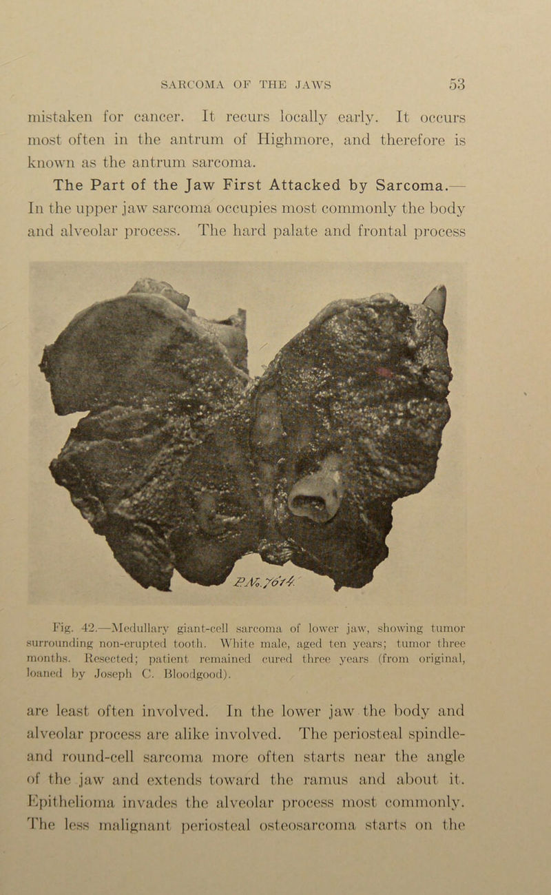 mistaken for cancer. It recurs locally early. It occurs most often in the antrum of Highmore, and therefore is known as the antrum sarcoma. The Part of the Jaw First Attacked by Sarcoma. In the upper jaw sarcoma occupies most commonly the body and alveolar process. The hard palate and frontal process Fig. 42.—Medullary giant-cell sarcoma of lower jaw, showing tumor surrounding non-erupted tooth. White male, aged ten years; tumor three months. Resected; patient remained cured three years (from original, loaned by Joseph C. Bloodgood). are least often involved. In the lower jaw the body and alveolar process are alike involved. The periosteal spindle- and round-cell sarcoma more often starts near the angle of the jaw and extends toward the ramus and about it. Epithelioma invades the alveolar process most commonly. The less malignant periosteal osteosarcoma starts on the