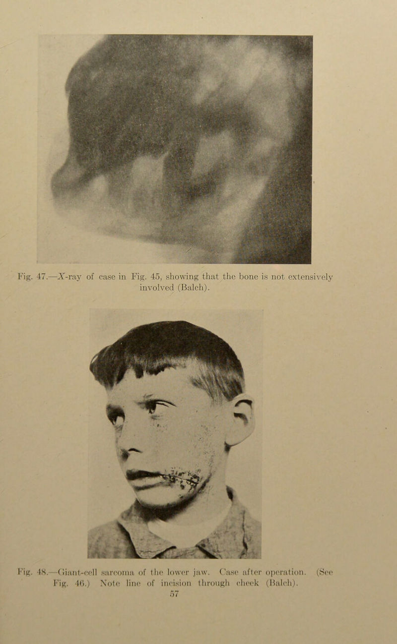 Fig. 47.—X-ray of case in Fig. 45, showing that the bone is not extensively involved (Balch). Fig. 4K.—Giant-cell sarcoma of the lower jaw. Case after operation. (See Fig. 4(i.) Note line of incision through cheek (Balch).