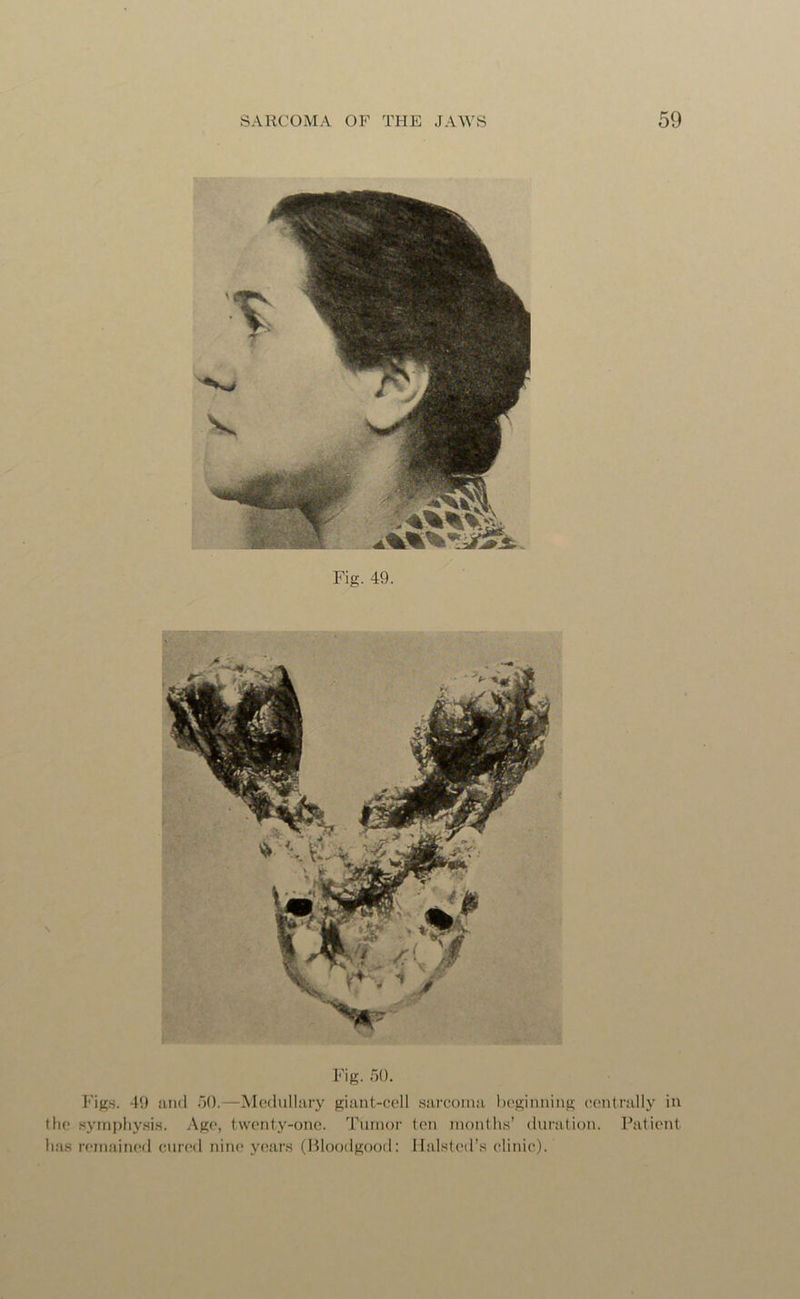 Fig. 49. Fig. 50. Figs. 49 and 50.—Medullary giant-cell sarcoma beginning centrally in the symphysis. Age, twenty-one. Tumor ten months’ duration. Patient has remained cured nine years (Bloodgood: Halsted’s clinic).
