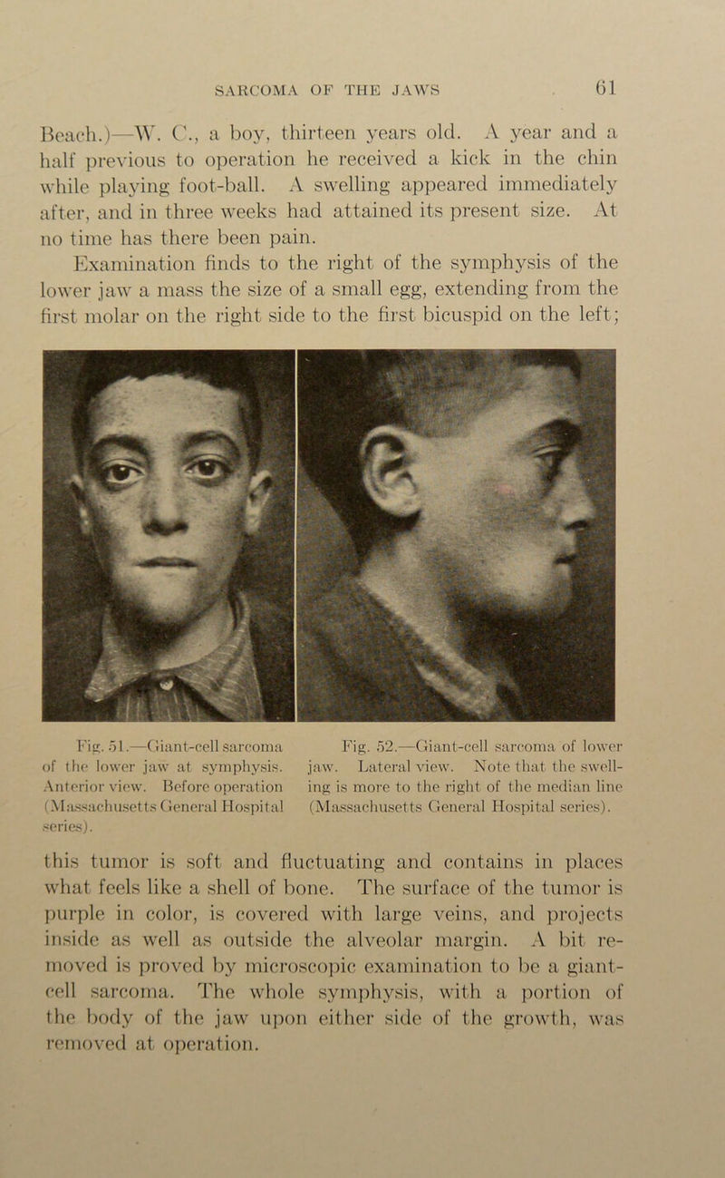 Beach.)—W. C., a boy, thirteen years old. A year and a half previous to operation he received a kick in the chin while playing foot-ball. A swelling appeared immediately after, and in three weeks had attained its present size. At no time has there been pain. Examination finds to the right of the symphysis of the lower jaw a mass the size of a small egg, extending from the first molar on the right side to the first bicuspid on the left; Fig. 51.—Giant-cell sarcoma of the lower jaw at symphysis. Anterior view. Before operation (Massachusetts General Hospital series). Fig. 52.—Giant-cell sarcoma of lower jaw. Lateral view. Note that the swell- ing is more to the right of the median line (Massachusetts General Hospital series). this tumor is soft and fluctuating and contains in places what feels like a shell of bone. The surface of the tumor is purple in color, is covered with large veins, and projects inside as well as outside the alveolar margin. A bit re- moved is proved by microscopic examination to be a giant- cell sarcoma. The whole symphysis, with a portion of the body of the jaw upon either side of the growth, was removed at operation.