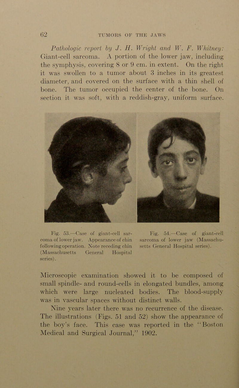 Pathologic report by J. H. Wright and W. F. Whitney: Giant-cell sarcoma. A portion of the lower jaw, including the symphysis, covering 8 or 9 cm. in extent. On the right it was swollen to a tumor about 3 inches in its greatest diameter, and covered on the surface with a thin shell of bone. The tumor occupied the center of the bone. On section it was soft, with a reddish-gray, uniform surface. Fig. 53.—Case of giant-cell sar- Fig. 54.—Case of giant-cell coma of lower jaw. Appearance of chin sarcoma of lower jaw (Massachu- followingoperation. Note receding chin setts General Hospital series). (Massachusetts General Hospital series). Microscopic examination showed it to be composed of small spindle- and round-cells in elongated bundles, among which were large nucleated bodies. The blood-supply was in vascular spaces without distinct walls. Nine years later there was no recurrence of the disease. The illustrations (Figs. 51 and 52) show the appearance of the boy’s face. This case was reported in the '‘Boston Medical and Surgical Journal,” 1902.