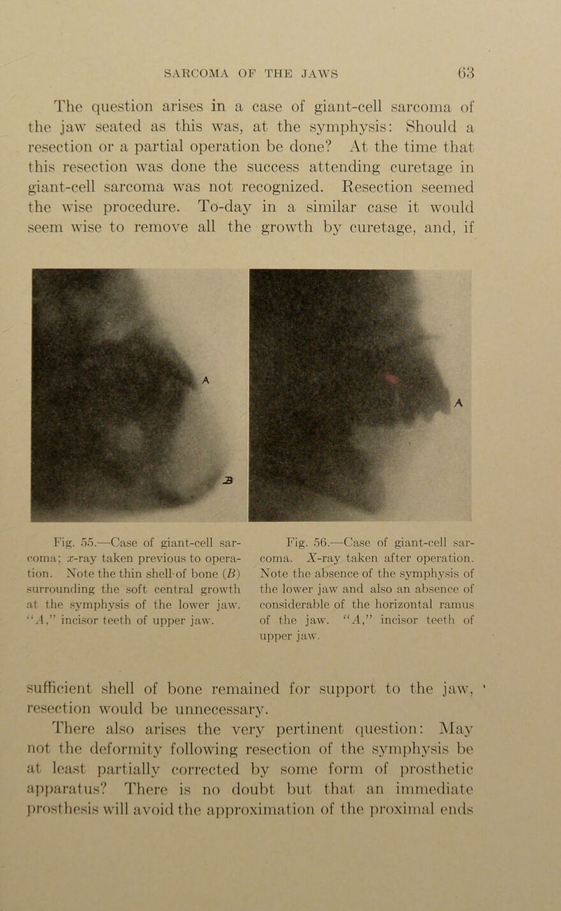 The question arises in a case of giant-cell sarcoma of the jaw seated as this was, at the symphysis: Should a resection or a partial operation be done? At the time that this resection was done the success attending curetage in giant-cell sarcoma was not recognized. Resection seemed the wise procedure. To-day in a similar case it would seem wise to remove all the growth by curetage, and, if Fig. 55.—Case of giant-cell sar- coma; x-ray taken previous to opera- tion. Note the thin shell of bone (B) surrounding the soft central growth at the symphysis of the lower jaw. “A,” incisor teeth of upper jaw. Fig. 56.—Case of giant-cell sar- coma. A”-ray taken after operation. Note the absence of the symphysis of the lower jaw and also an absence of considerable of the horizontal ramus of the jaw. “A,” incisor teeth of upper jaw. sufficient shell of bone remained for support to the jaw, 1 resection would be unnecessary. There also arises the very pertinent question: May not the deformity following resection of the symphysis be at least partially corrected by some form of prosthetic apparatus? There is no doubt but that an immediate prosthesis will avoid the approximation of the proximal ends