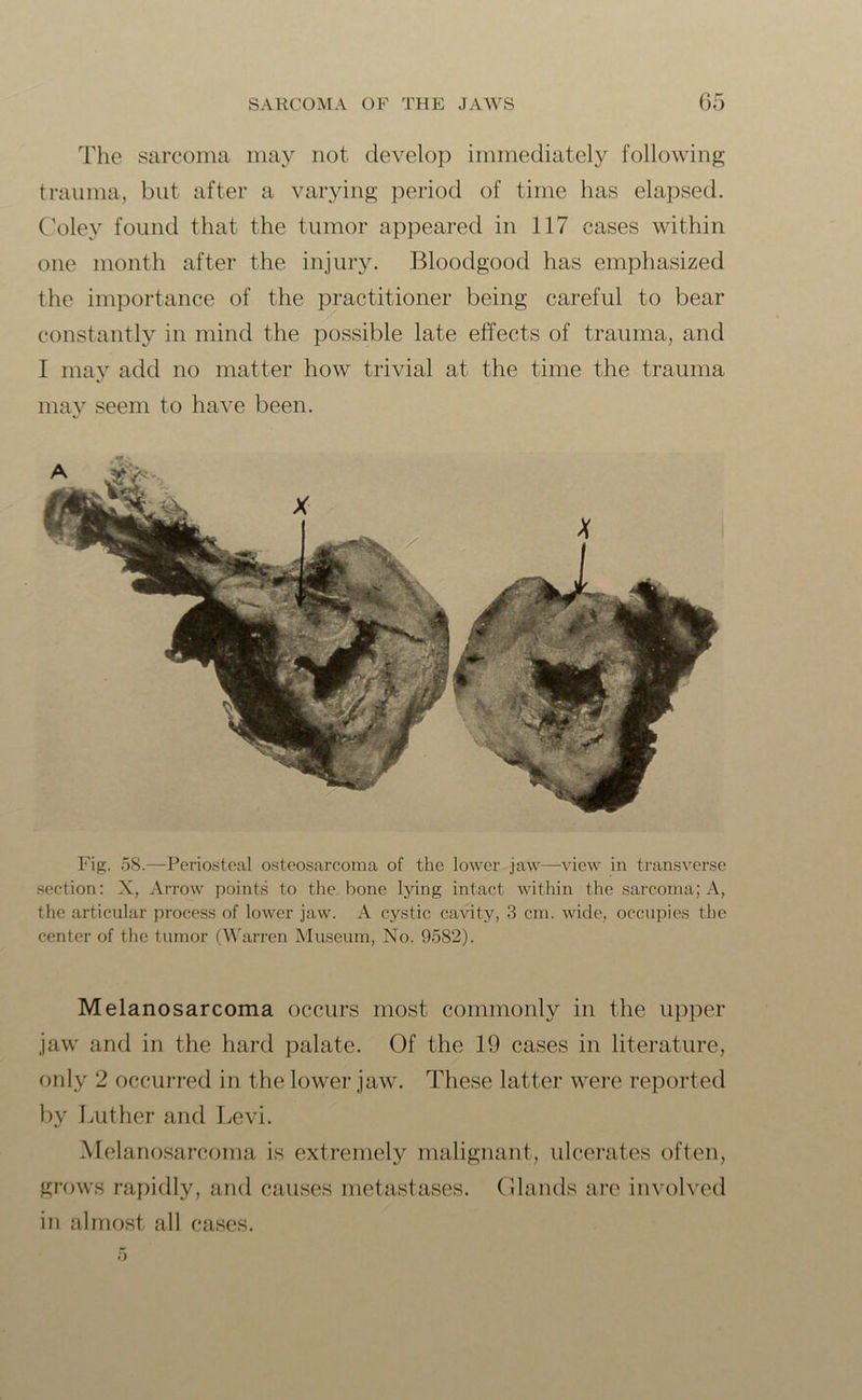 The sarcoma may not develop immediately following trauma, but after a varying period of time has elapsed. Coley found that the tumor appeared in 117 cases within one month after the injury. Bloodgood has emphasized the importance of the practitioner being careful to bear constantly in mind the possible late effects of trauma, and I may add no matter how trivial at the time the trauma may seem to have been. Fig. 58.—Periosteal osteosarcoma of the lower jaw—view in transverse section: X, Arrow points to the bone lying intact within the sarcoma; A, the articular process of lower jaw. A cystic cavity, 3 cm. wide, occupies the center of the tumor (Warren Museum, No. 9582). Melanosarcoma occurs most commonly in the upper jaw and in the hard palate. Of the 19 cases in literature, only 2 occurred in the lower jaw. These latter were reported by 1 Ait her and Levi. Melanosarcoma is extremely malignant, ulcerates often, grows rapidly, and causes metastases. Glands are involved in almost all cases.