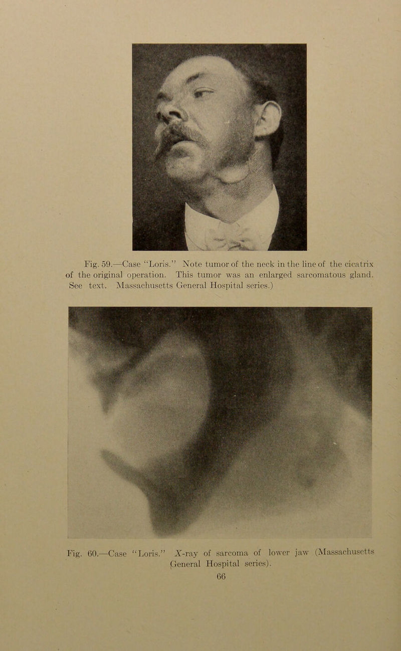 Fig. 59.—Case “Loris.” Note tumor of the neck in the line of the cicatrix of the original operation. This tumor was an enlarged sarcomatous gland. See text. Massachusetts General Hospital series.) Fig. 60.—Case “Loris.” X-ray of sarcoma of lower jaw (Massachusetts General Hospital series).