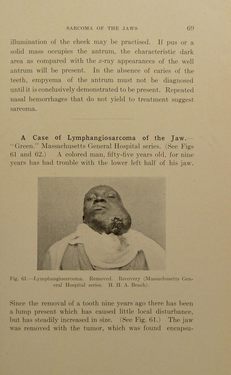 illumination of the cheek may be practised. If pus or a solid mass occupies the antrum, the characteristic dark area as compared with the x-ray appearances of the well antrum will be present. In the absence of caries of the teeth, empyema of the antrum must not be diagnosed until it is conclusively demonstrated to be present. Repeated nasal hemorrhages that do not yield to treatment suggest sarcoma. A Case of Lymphangiosarcoma of the Jaw. “ Green.” Massachusetts General Hospital series. (See Figs 61 and 62.) A colored man, fifty-five years old, for nine years has had trouble with the lower left half of his jaw. Fig. 61.—Lymphangiosarcoma. Removed. Recovery (Massachusetts Gen- eral Hospital series. H. H. A. Beach). Since the removal of a tooth nine years ago there has been a lump present which has caused little local disturbance, but has steadily increased in size. (See Fig. 61.) The jaw was removed with the tumor, which was found encapsu-
