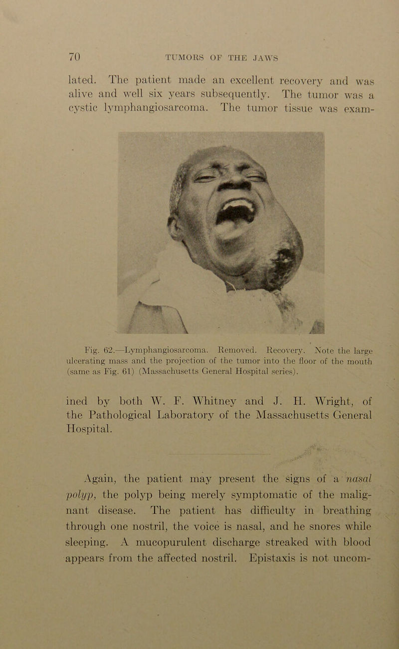 latecl. The patient made an excellent recovery and was alive and well six years subsequently. The tumor was a cystic lymph angiosarcoma. The tumor tissue was exam- Fig. 62.—Lymphangiosarcoma. Removed. Recovery. Note the large ulcerating mass and the projection of the tumor into the floor of the mouth (same as Fig. 61) (Massachusetts General Hospital series). ined by both W. F. Whitney and J. FI. Wright, of the Pathological Laboratory of the Massachusetts General Hospital. Again, the patient may present the signs of a nasal polyp, the polyp being merely symptomatic of the malig- nant disease. The patient has difficulty in breathing through one nostril, the voice is nasal, and he snores while sleeping. A mucopurulent discharge streaked with blood appears from the affected nostril. Epistaxis is not uncom-